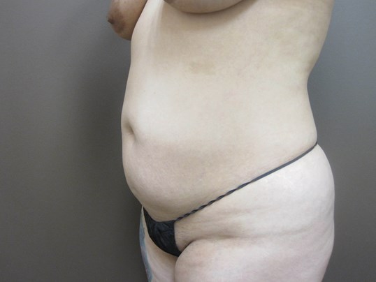 Liposuction Before