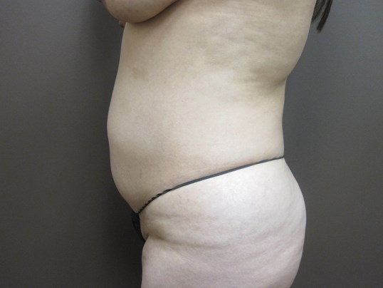 Liposuction Before