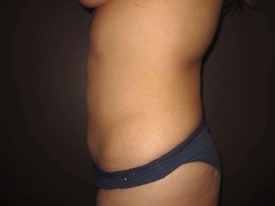 Liposuction After