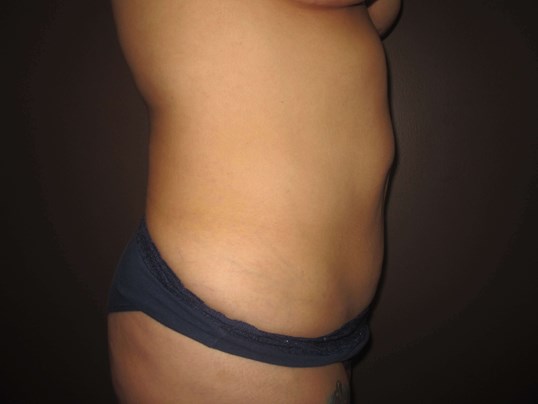 Liposuction After