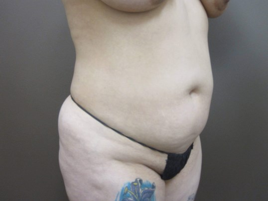 Liposuction Before