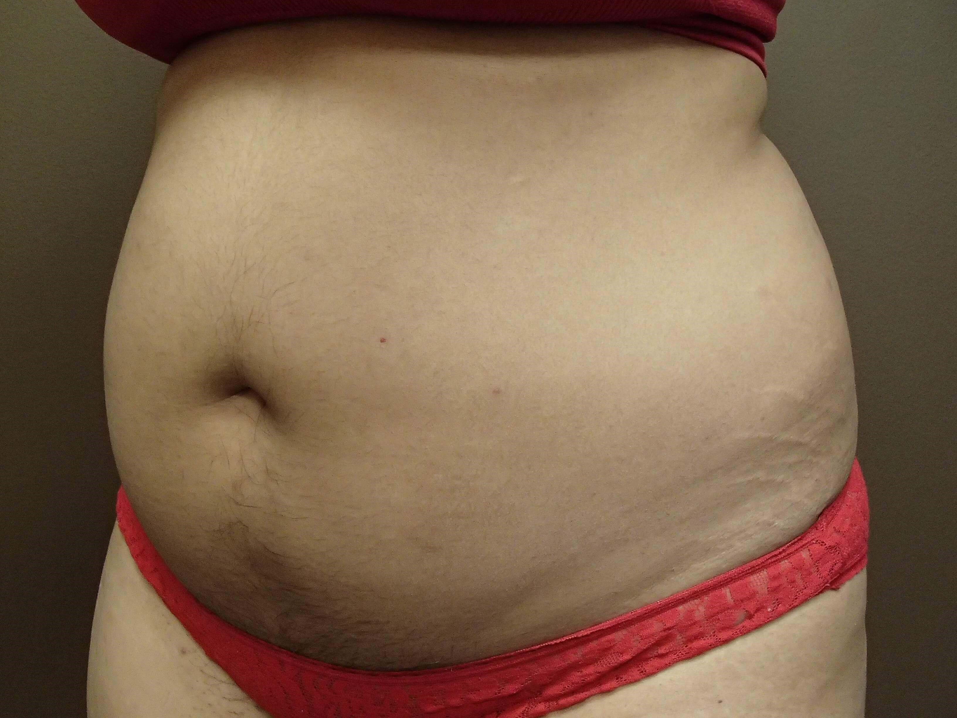 Liposuction Before