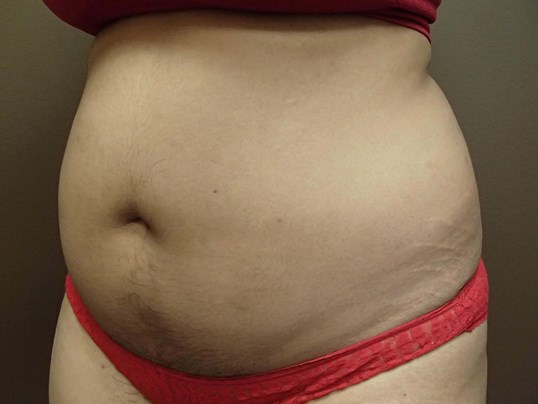 Liposuction Before