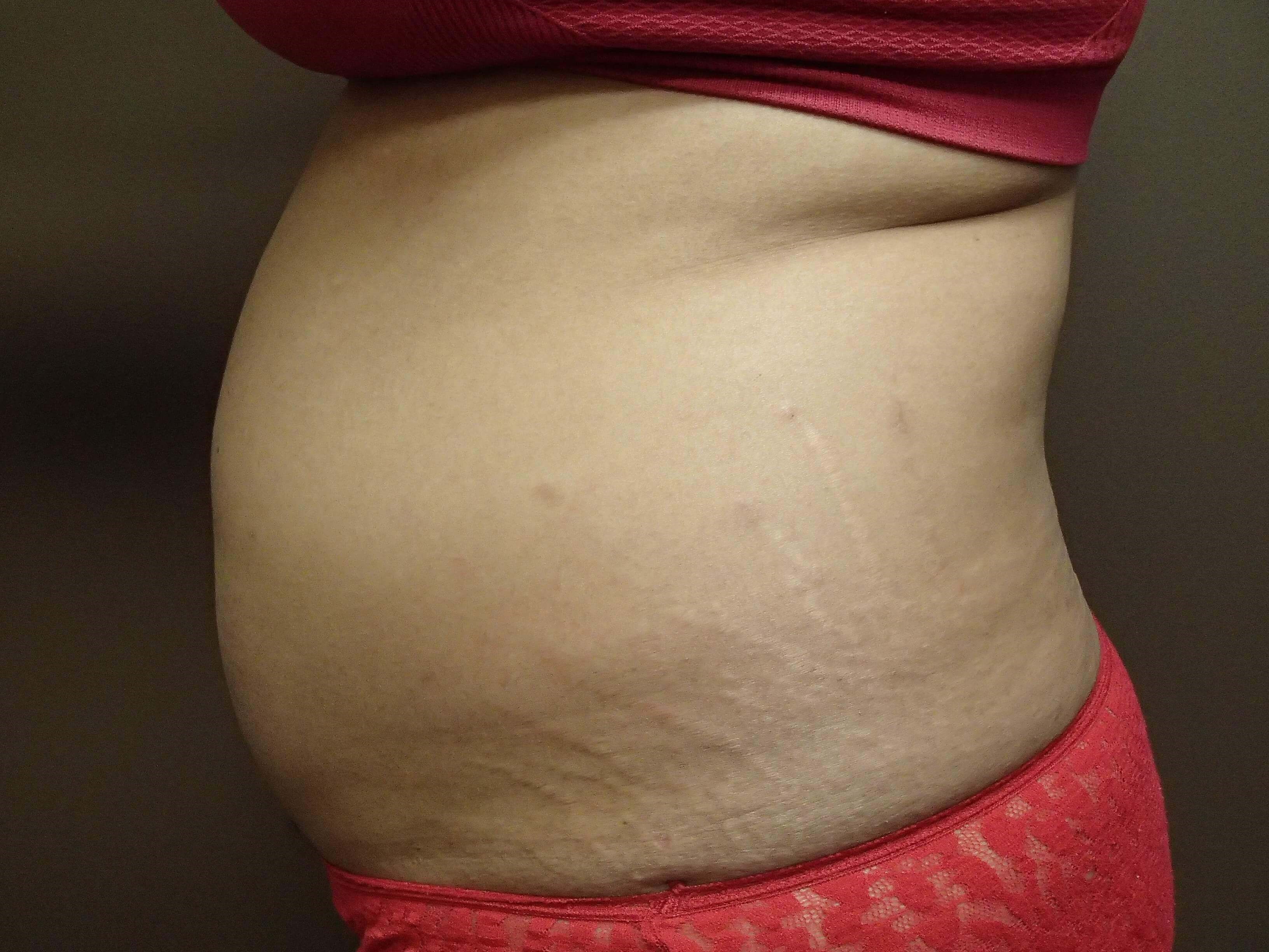 Liposuction Before