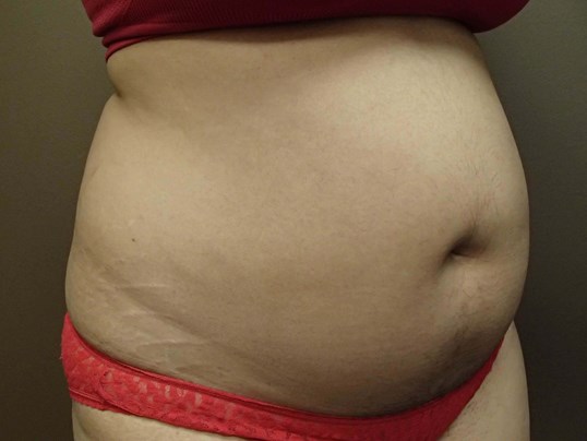 Liposuction Before