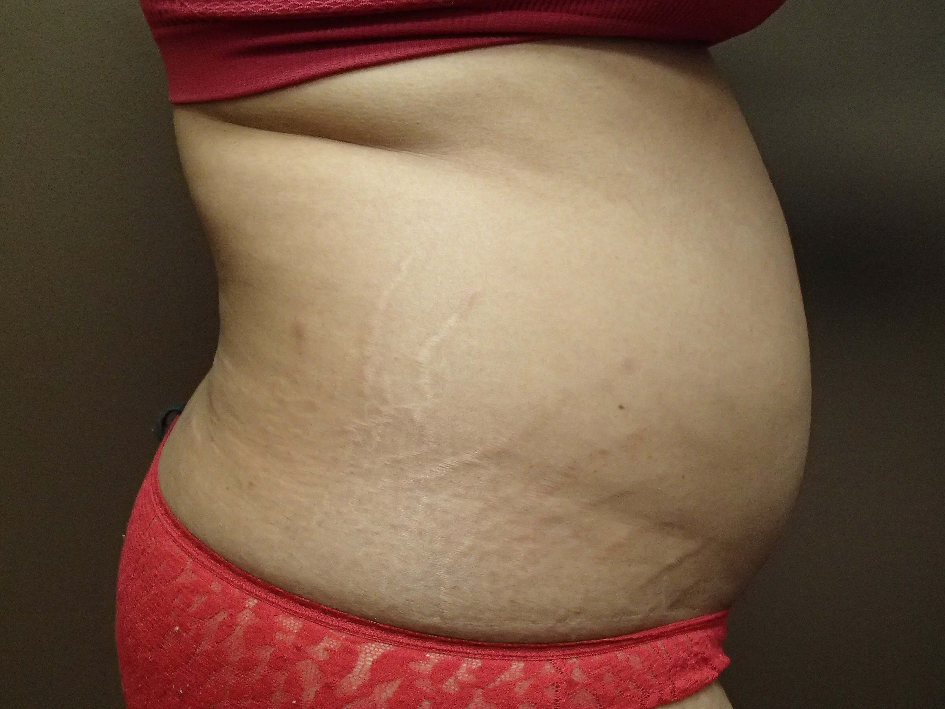Liposuction Before