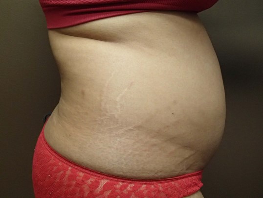Liposuction Before