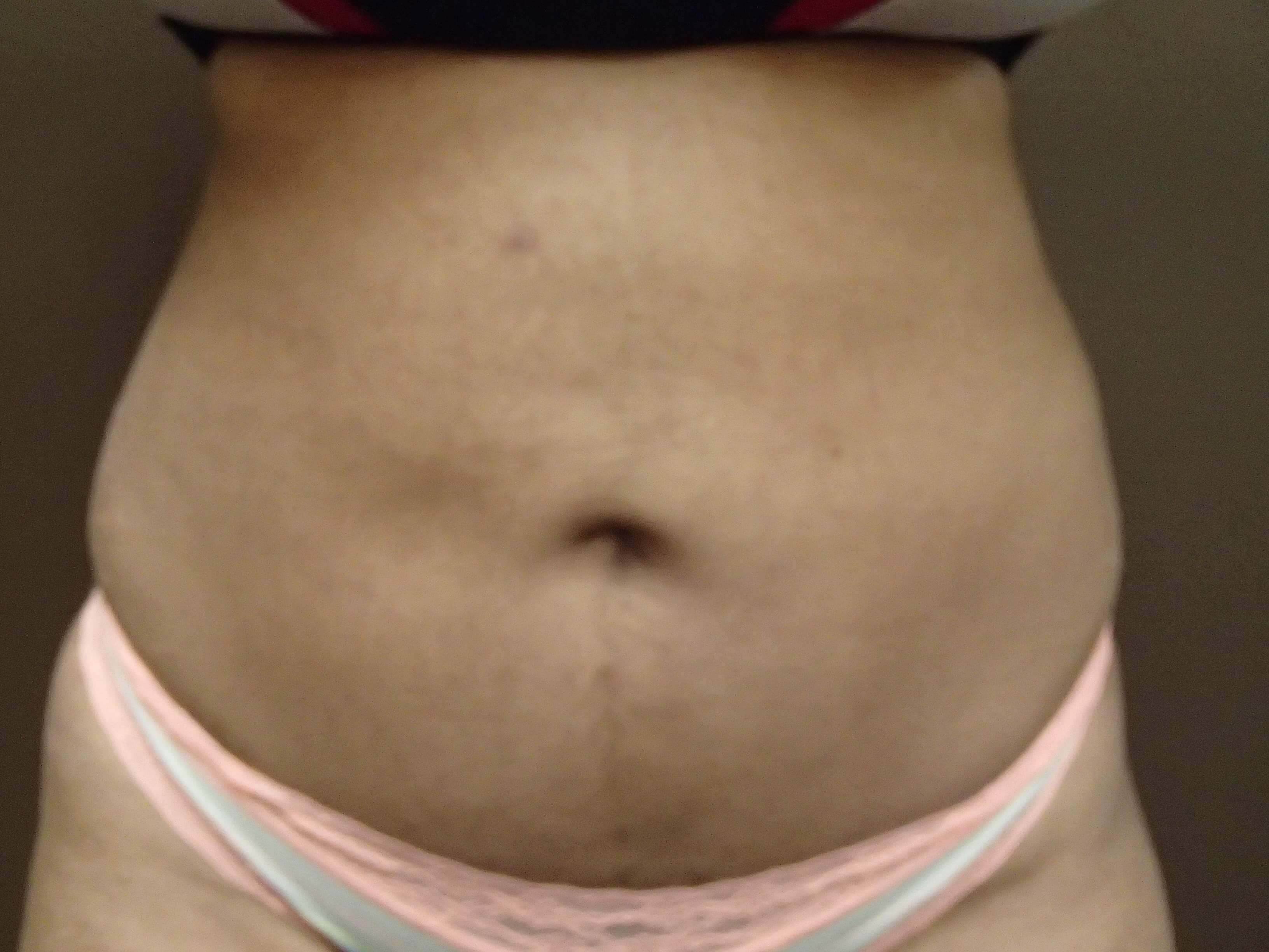 Liposuction After