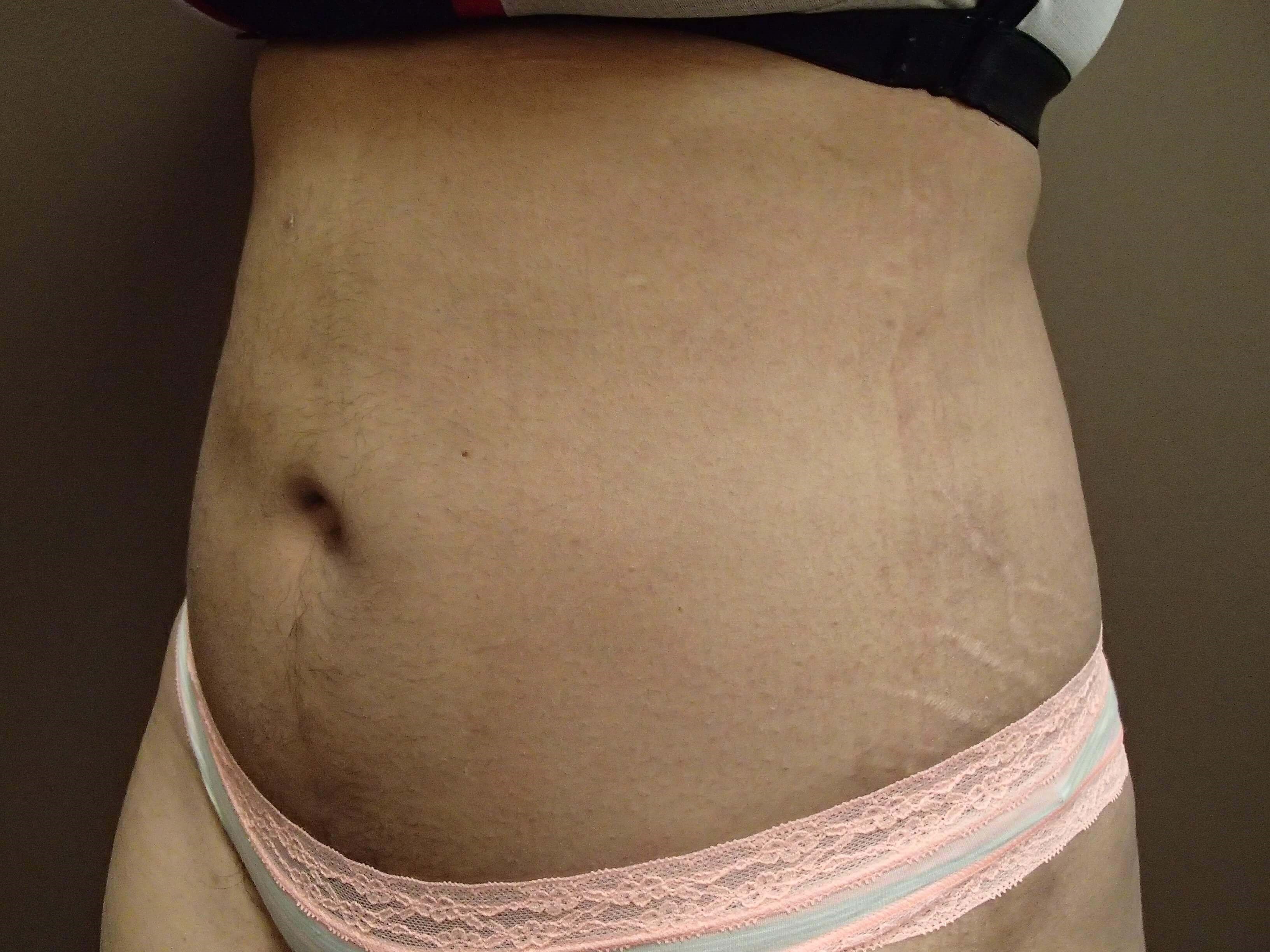 Liposuction After