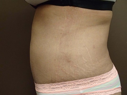 Liposuction After