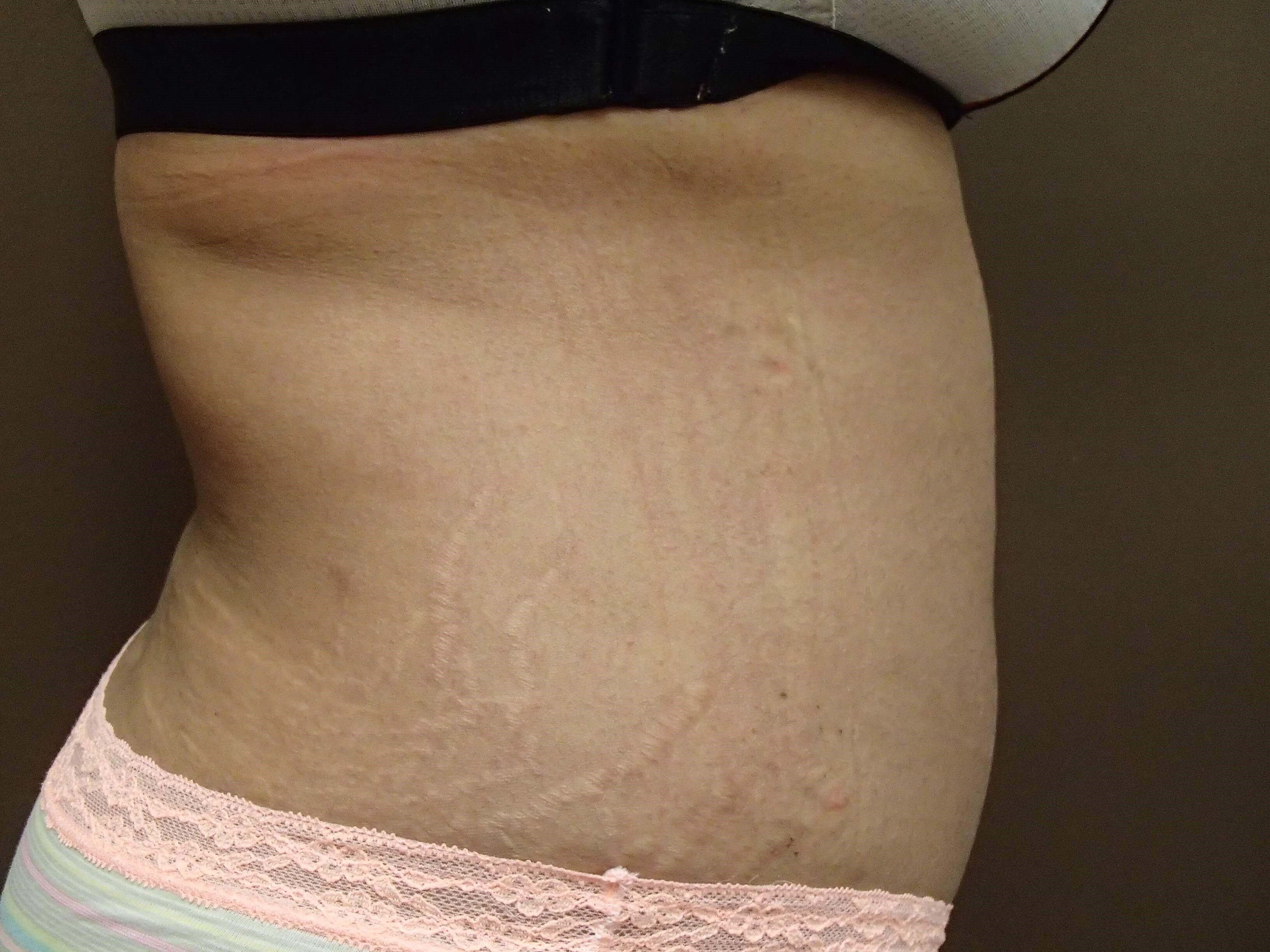 Liposuction After