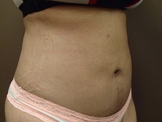 Liposuction After