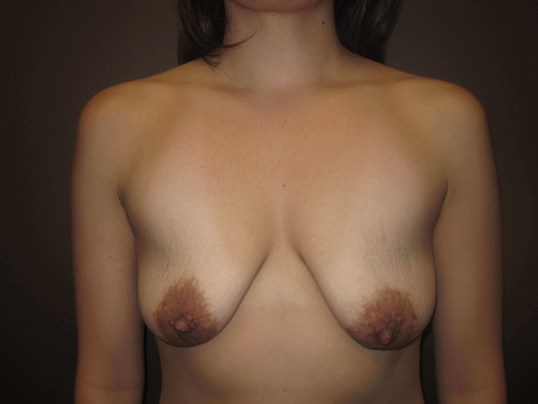 Breast Lift with Implant Before
