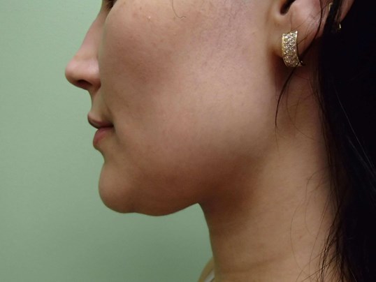 Liposuction Before