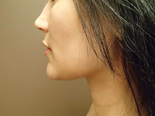Liposuction After