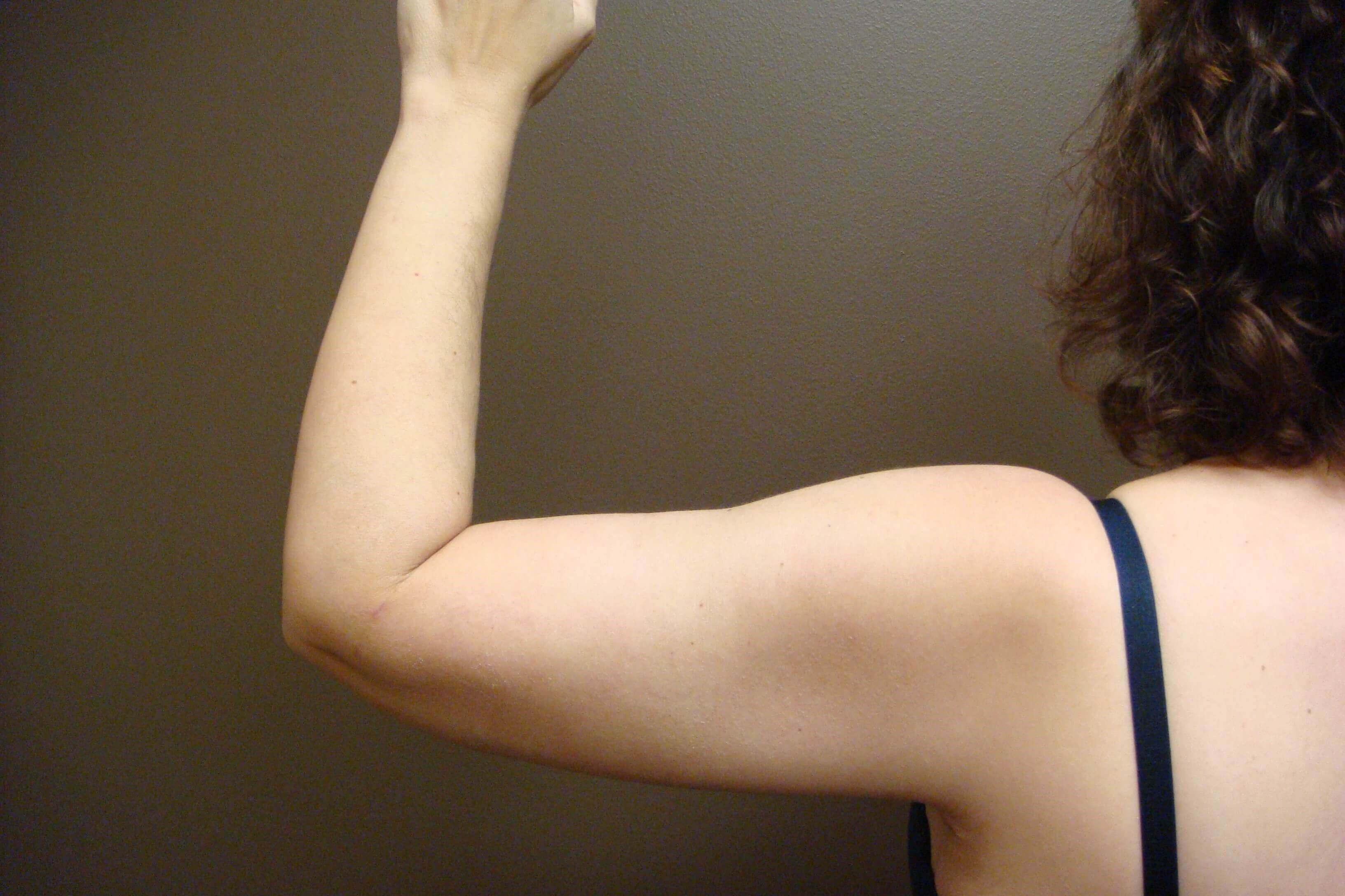Brachioplasty (Arm Lift) After