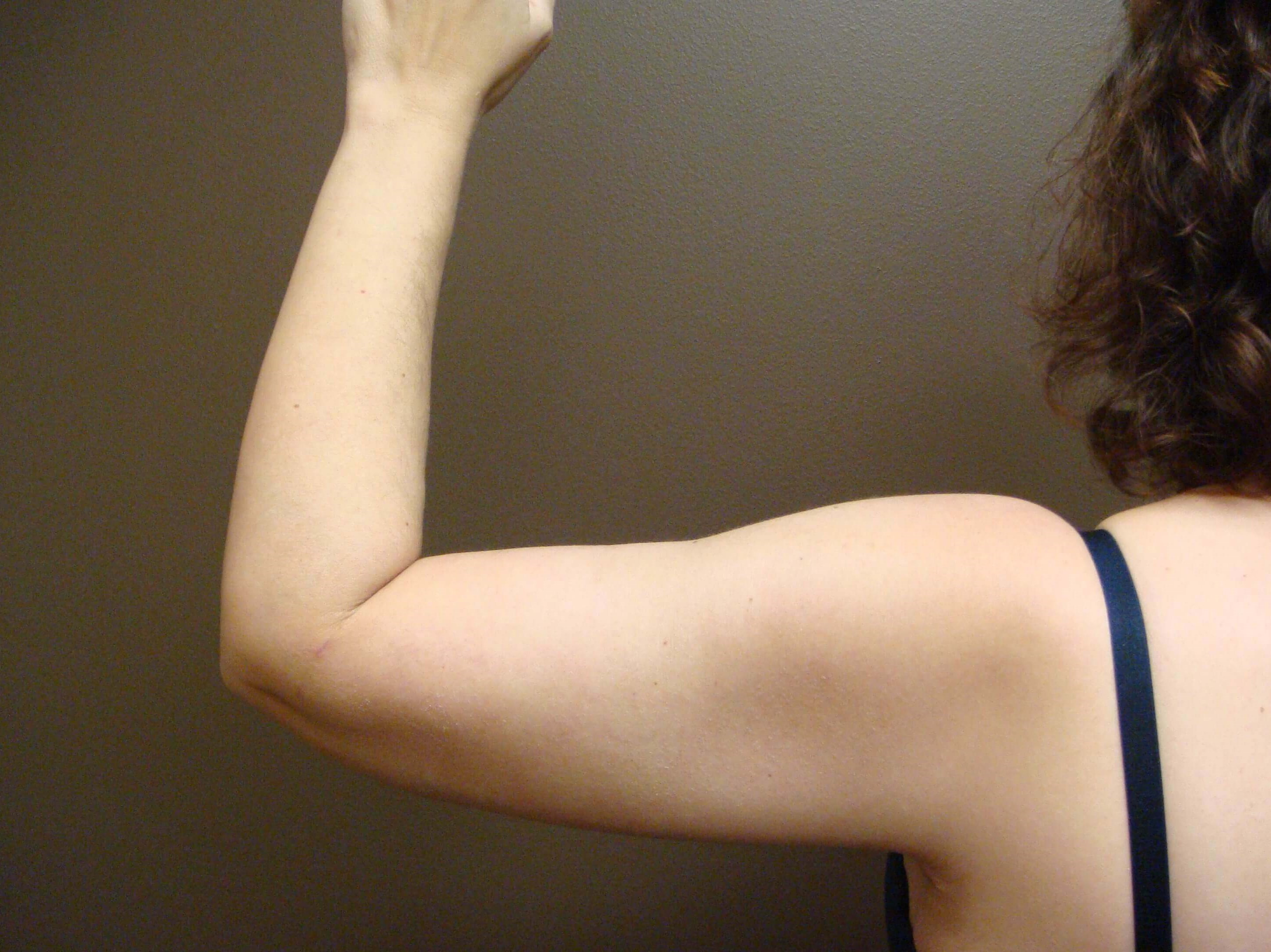 Brachioplasty (Arm Lift) After