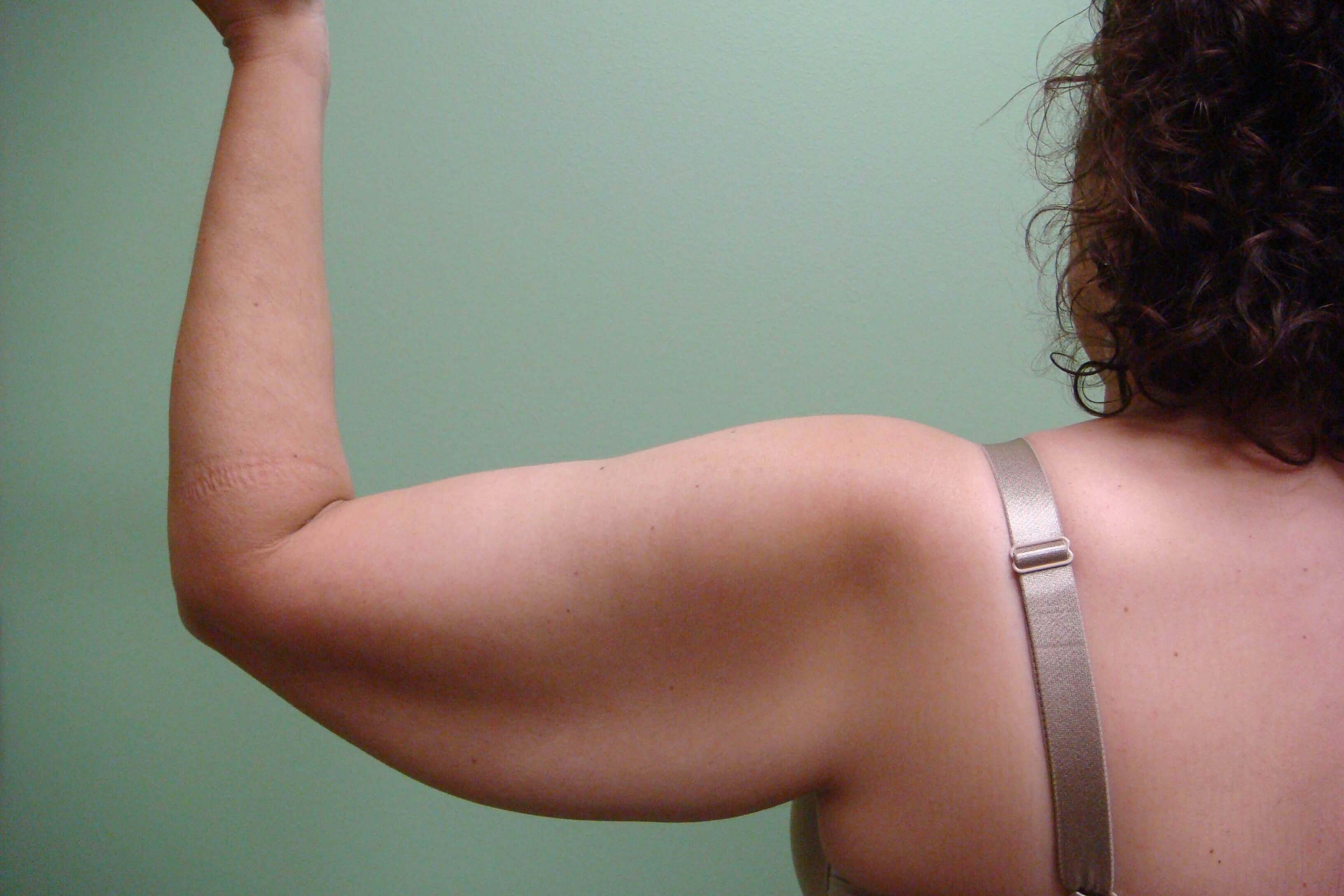 Brachioplasty (Arm Lift) Before