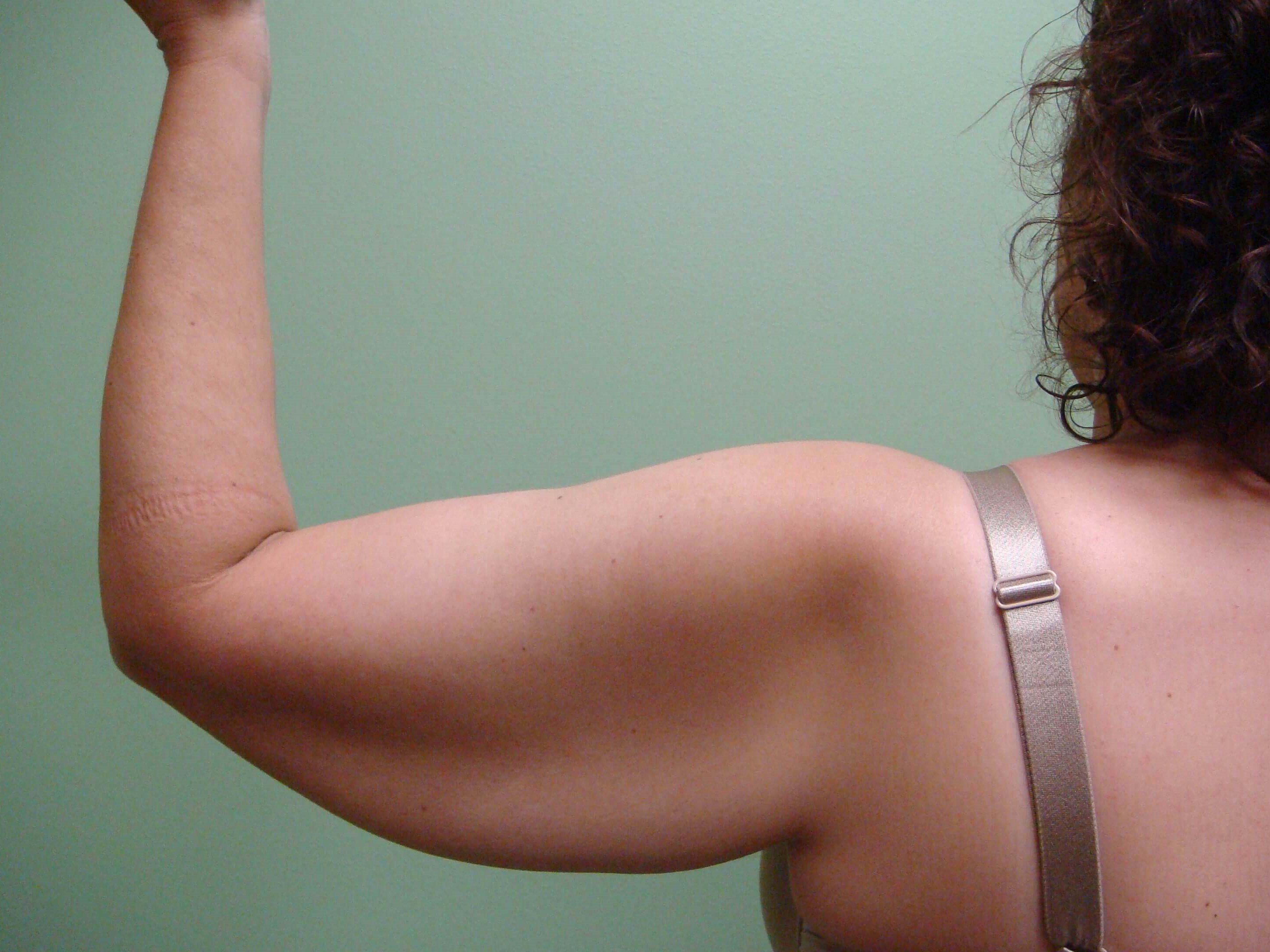 Brachioplasty (Arm Lift) Before