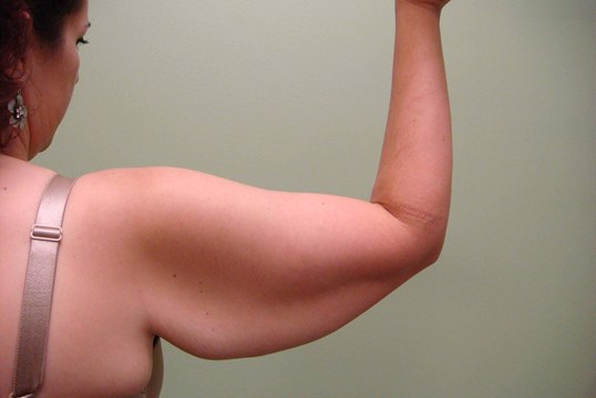 Brachioplasty (Arm Lift) Before