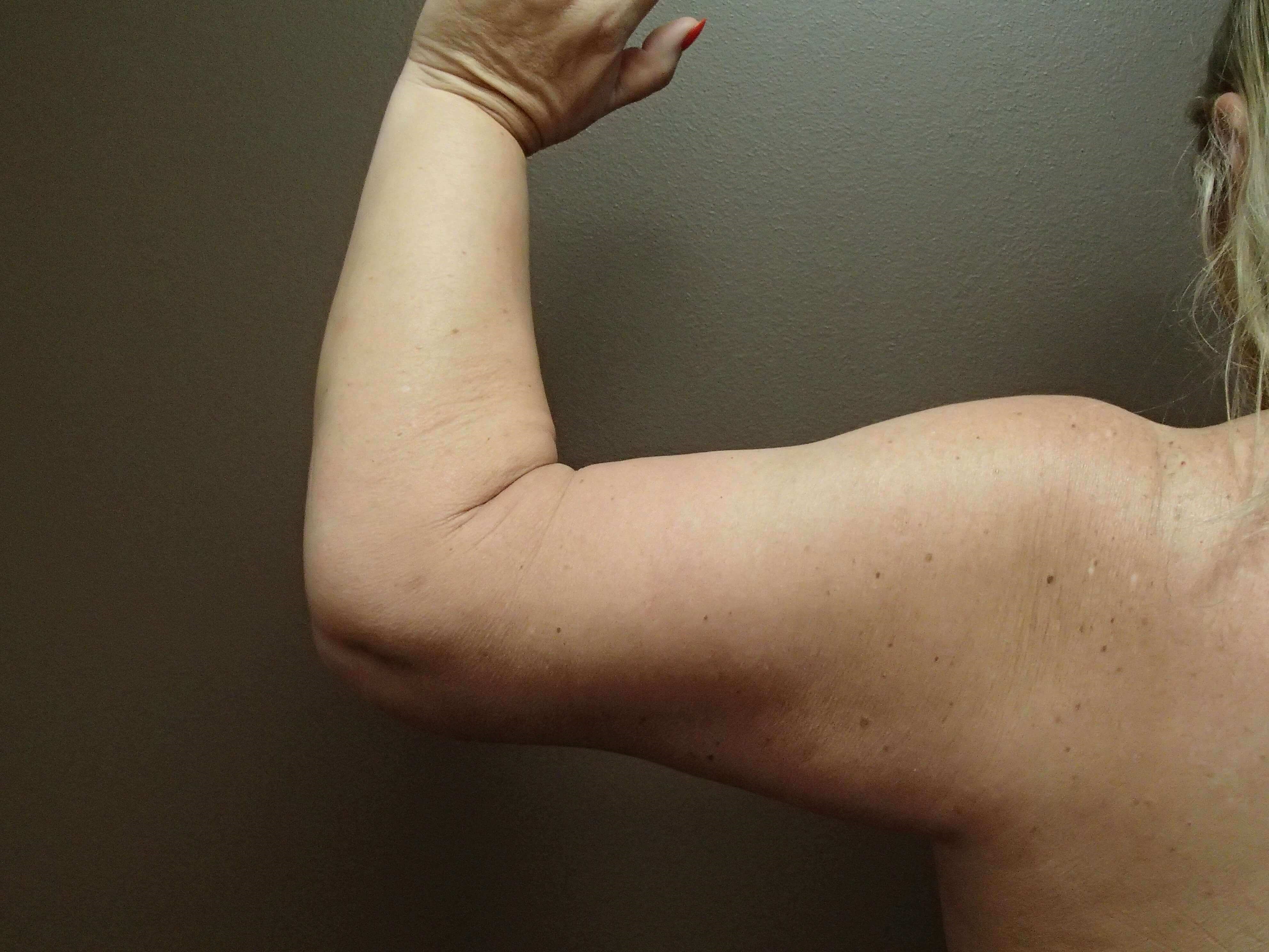 Brachioplasty (Arm Lift) After
