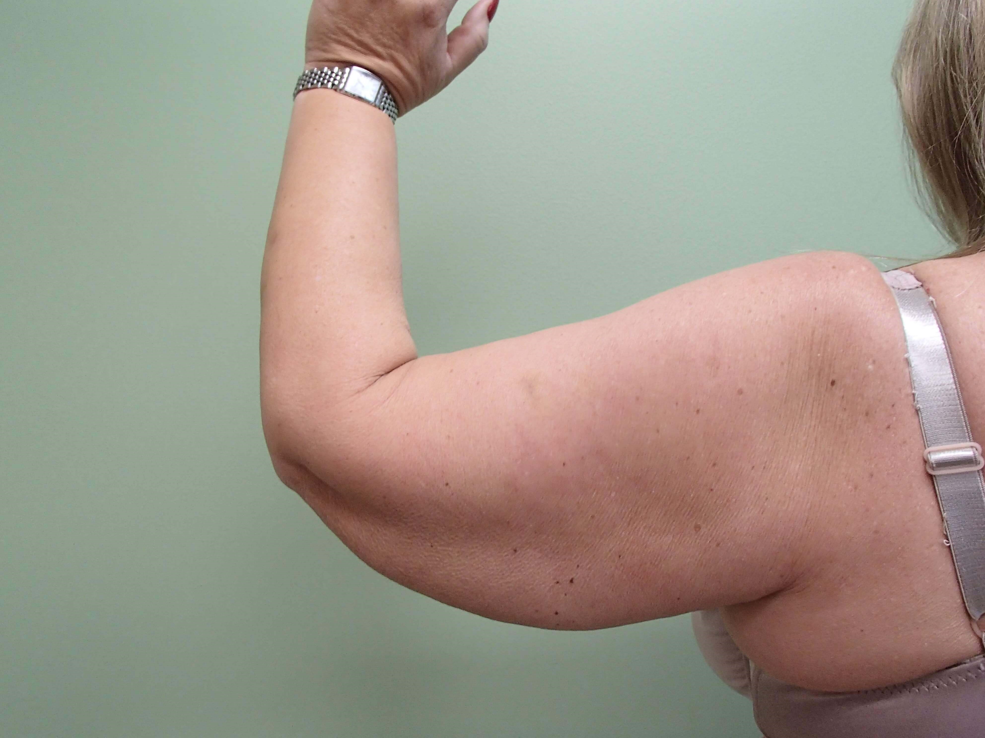 Brachioplasty (Arm Lift) Before
