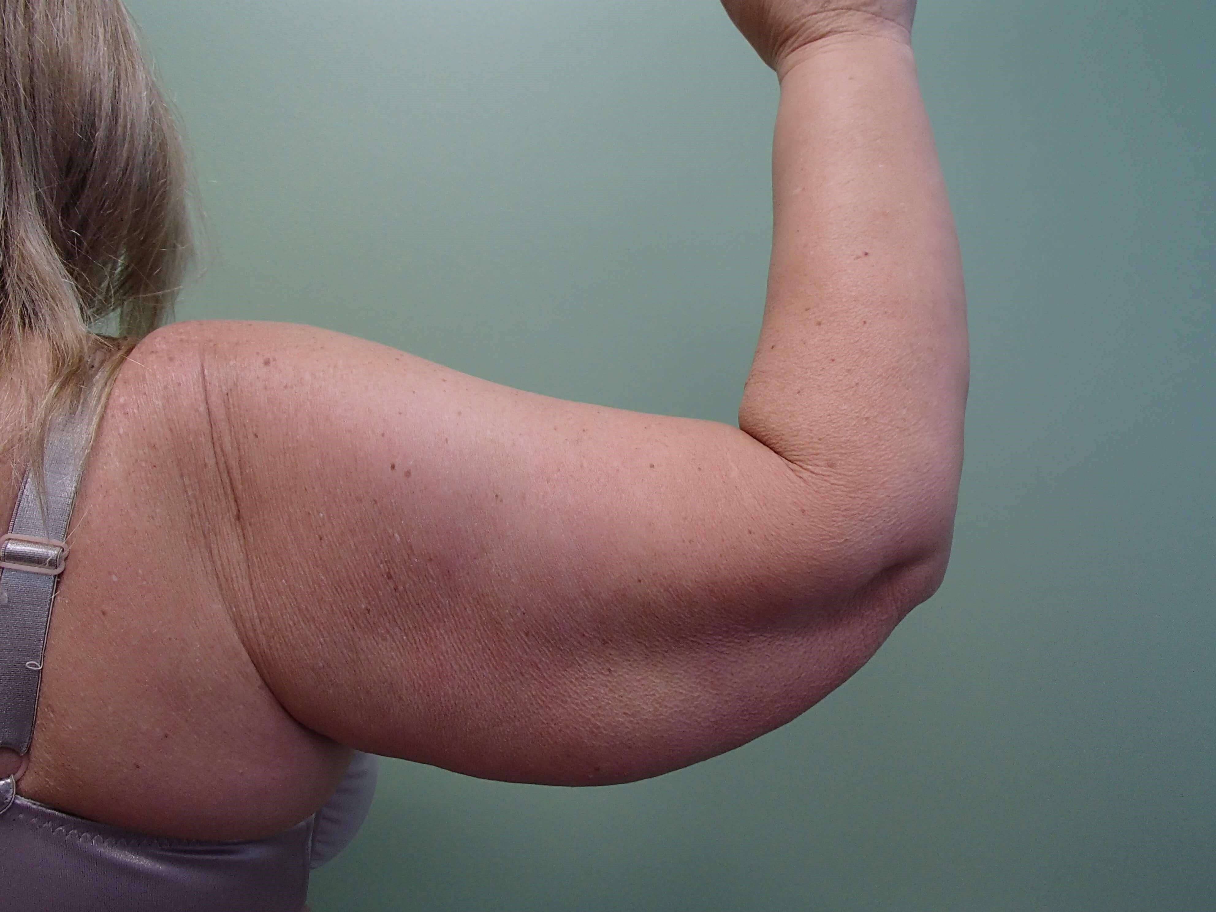 Brachioplasty (Arm Lift) Before