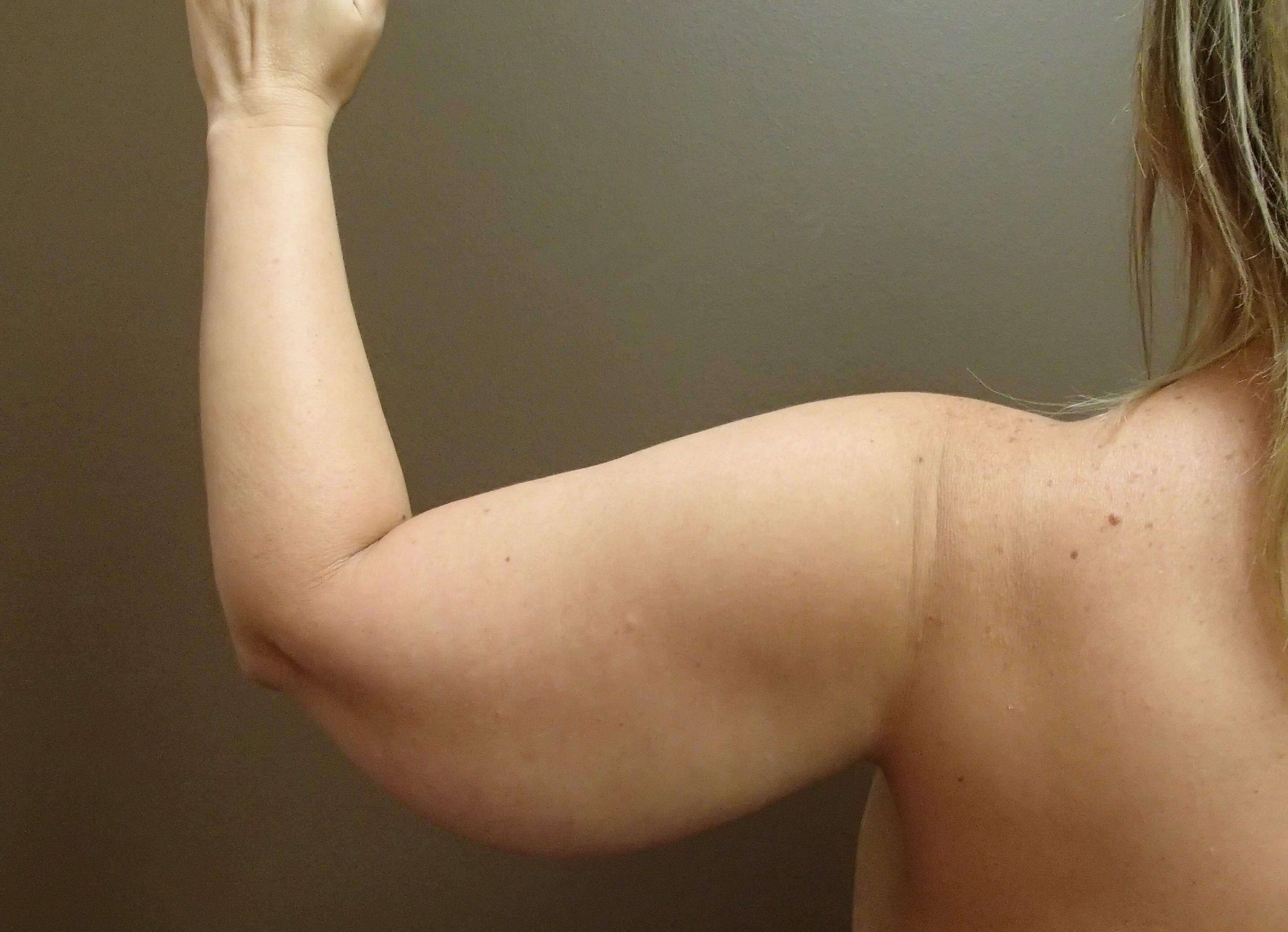 Brachioplasty (Arm Lift) Before