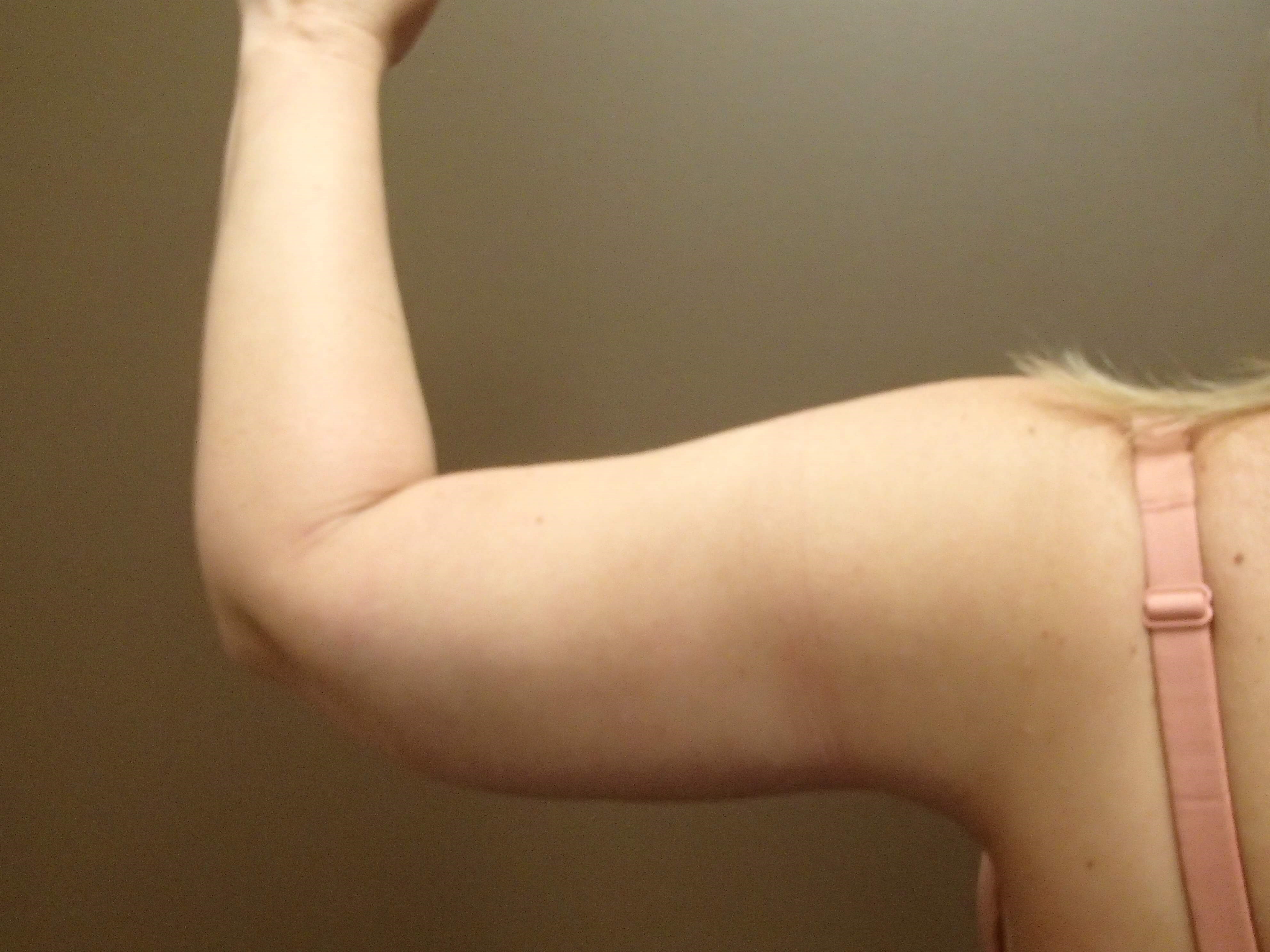 Brachioplasty (Arm Lift) After