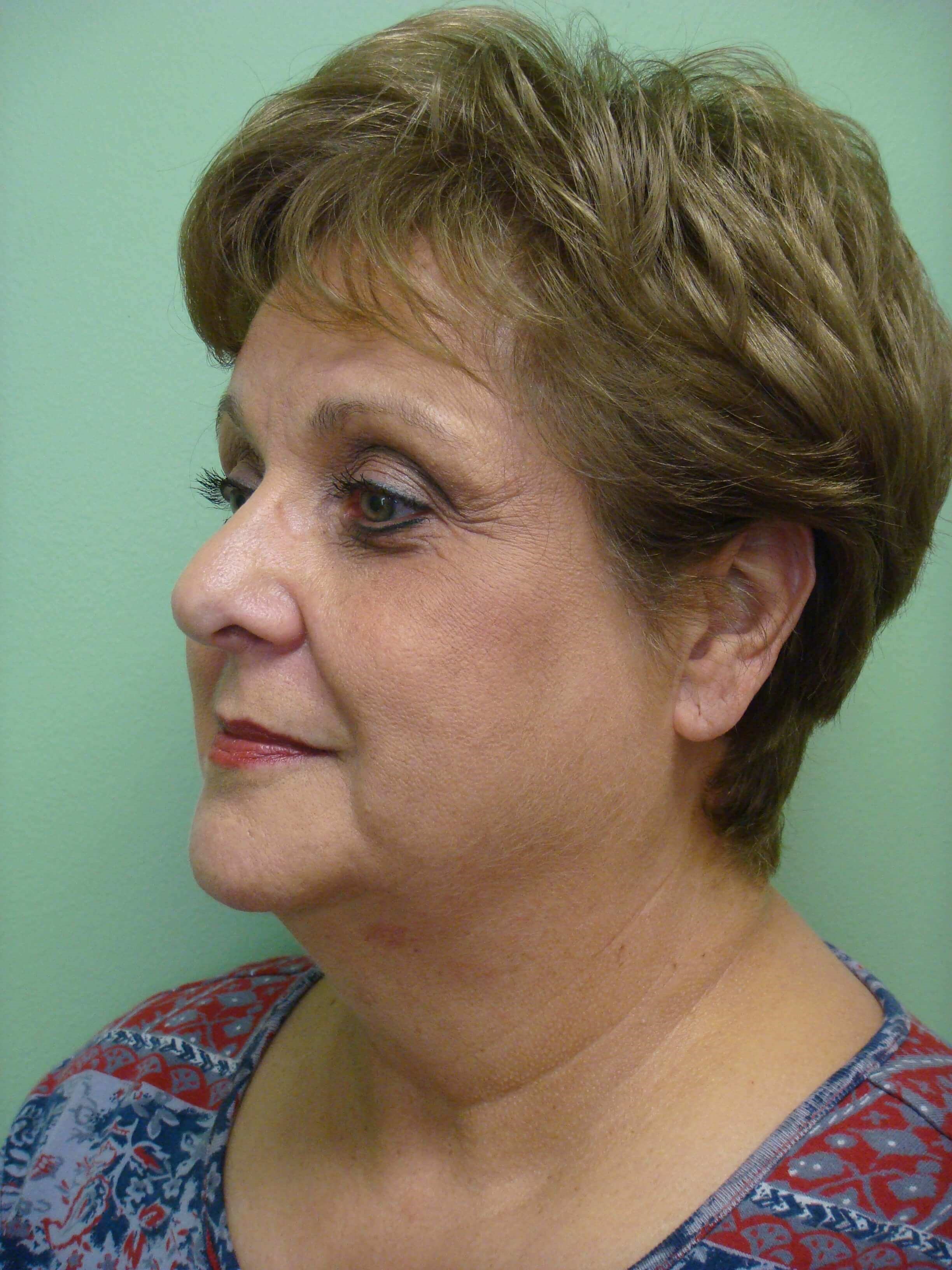 Facelift and Necklift Before