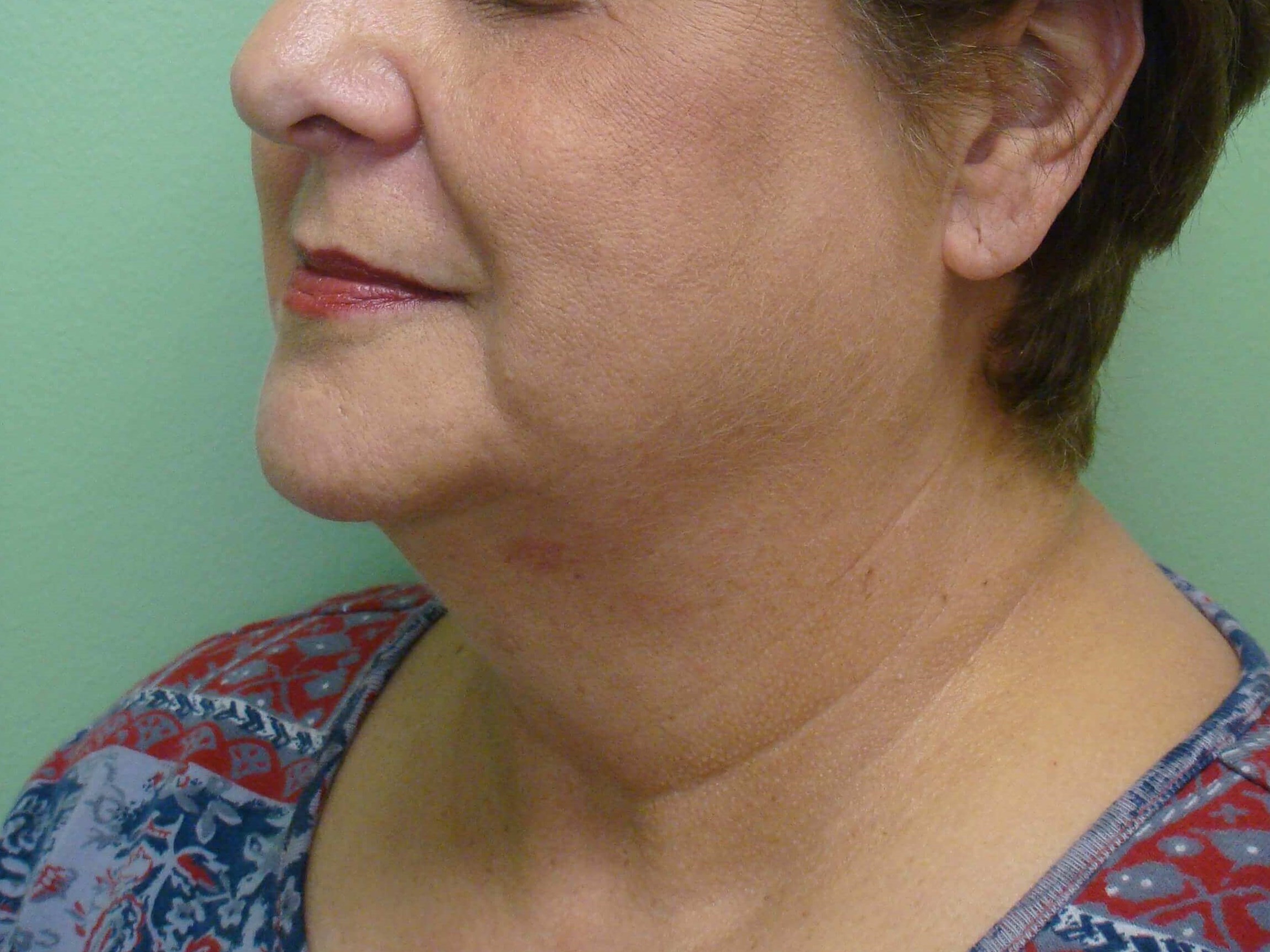 Facelift and Necklift Before