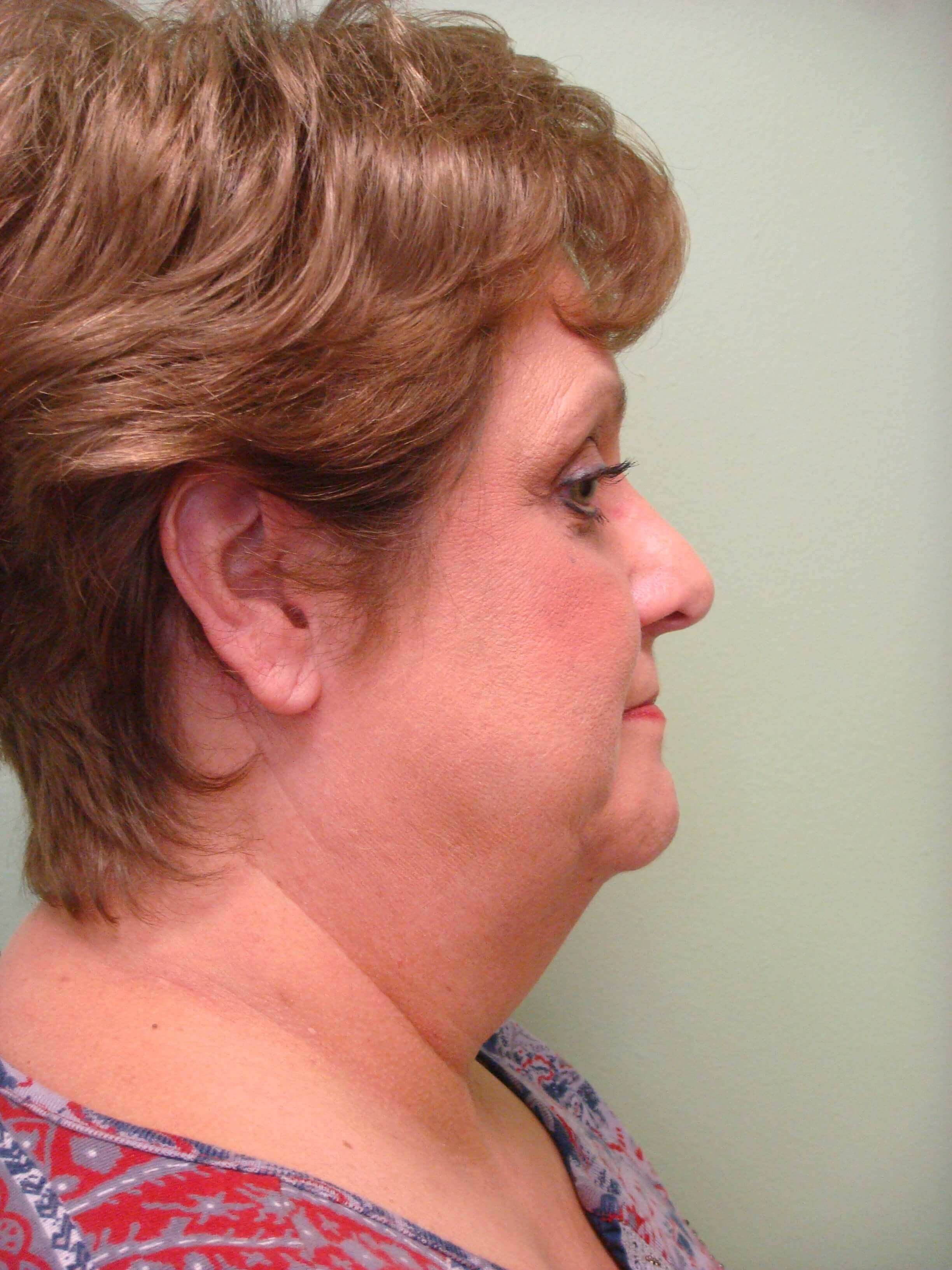 Facelift and Necklift Before