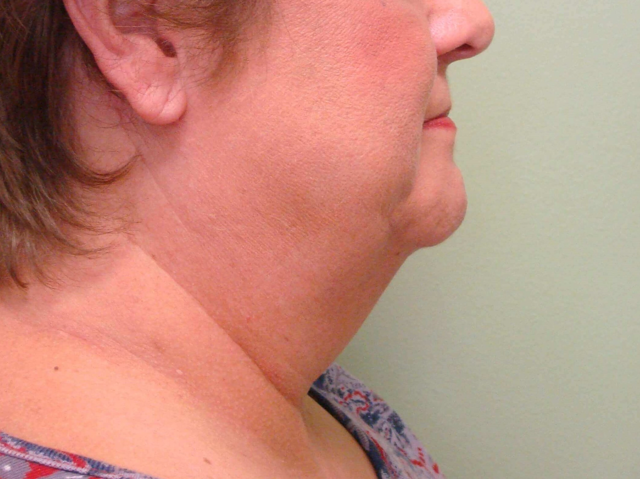 Facelift and Necklift Before