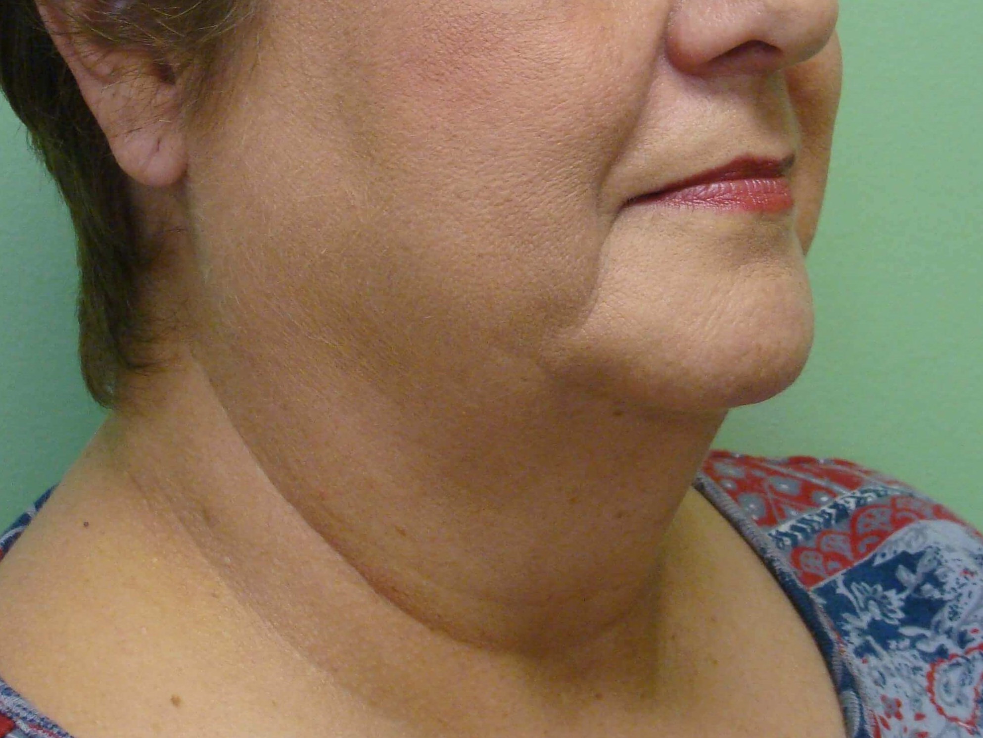 Facelift and Necklift Before