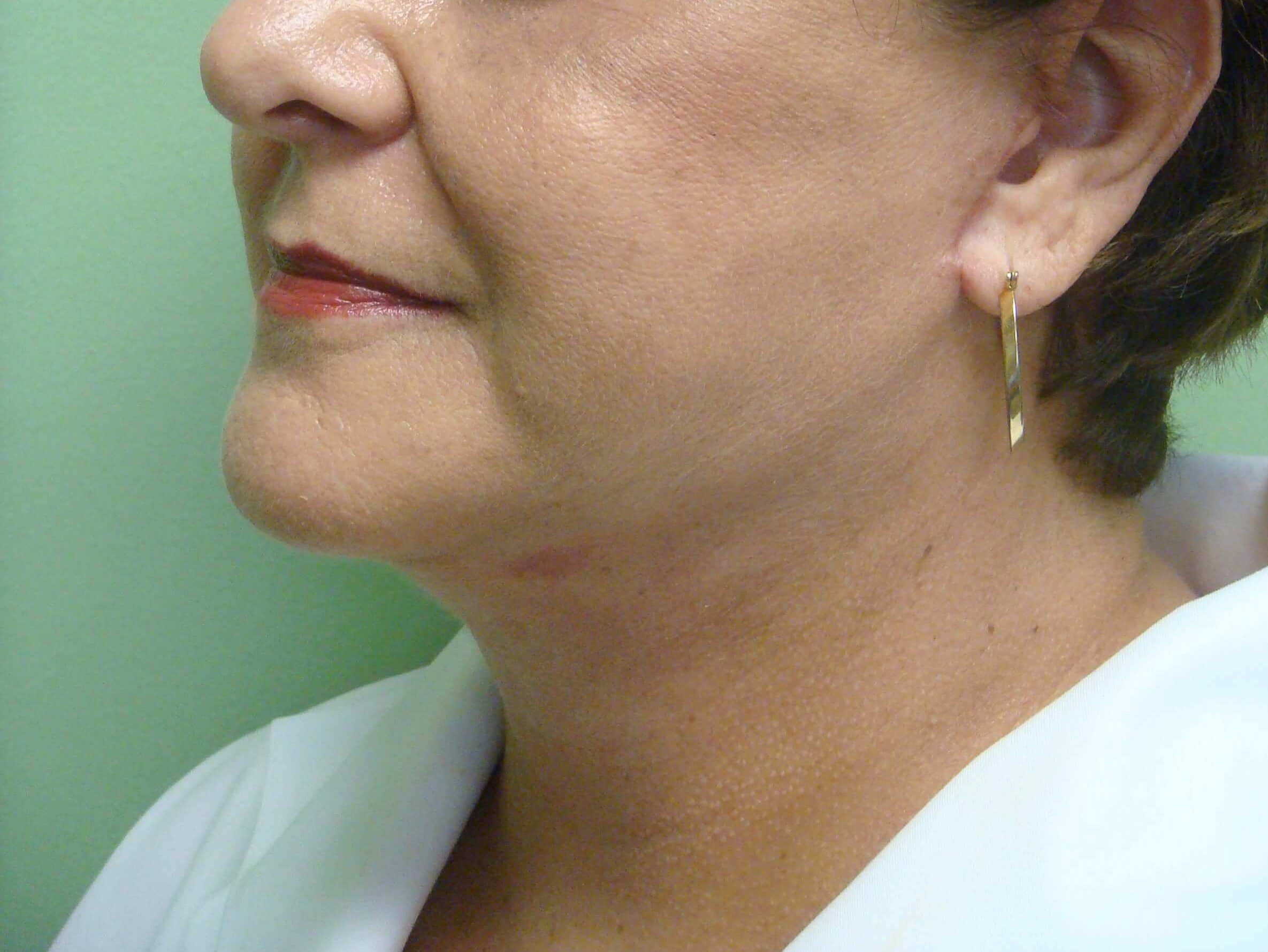 Facelift and Necklift After