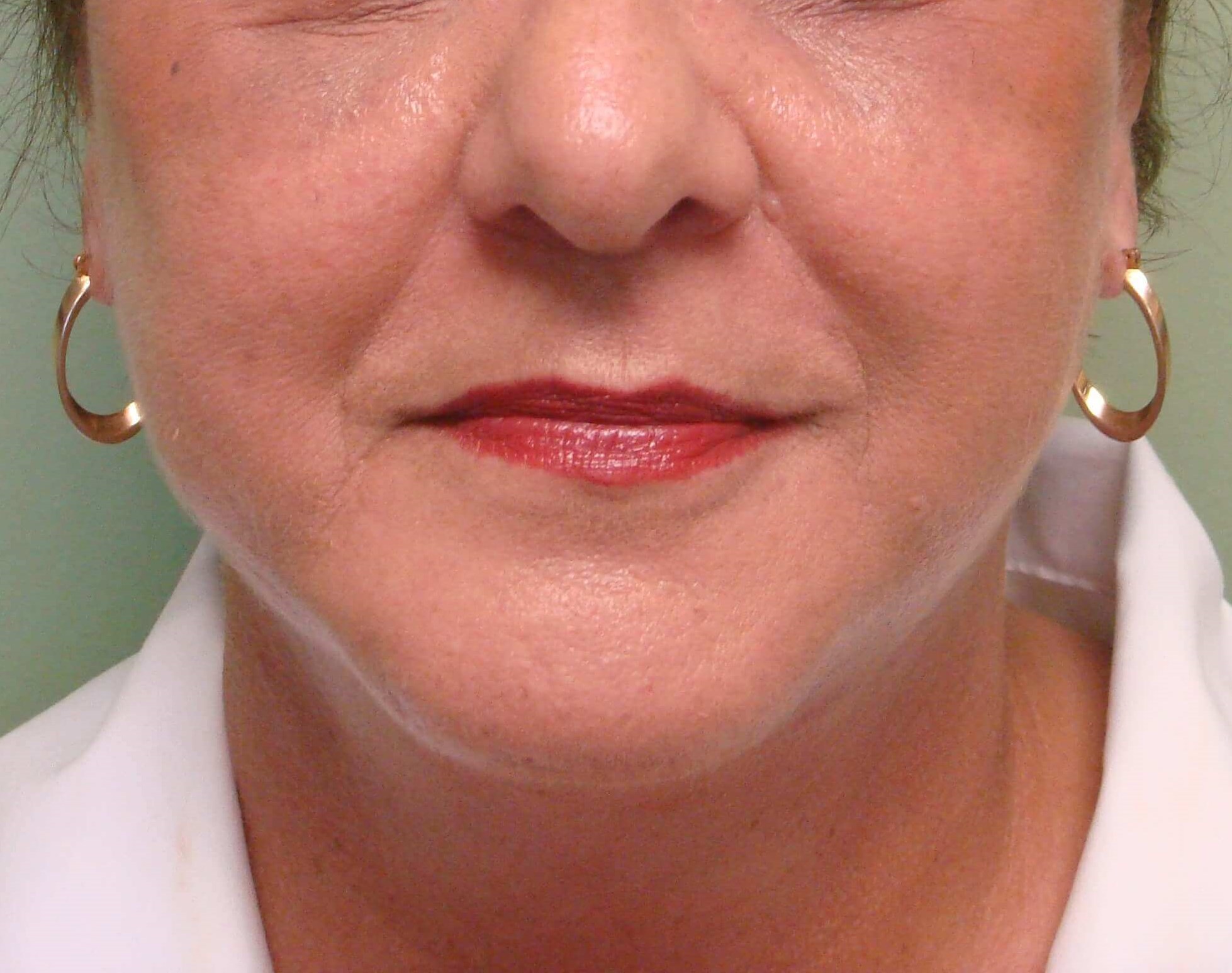 Facelift and Necklift After