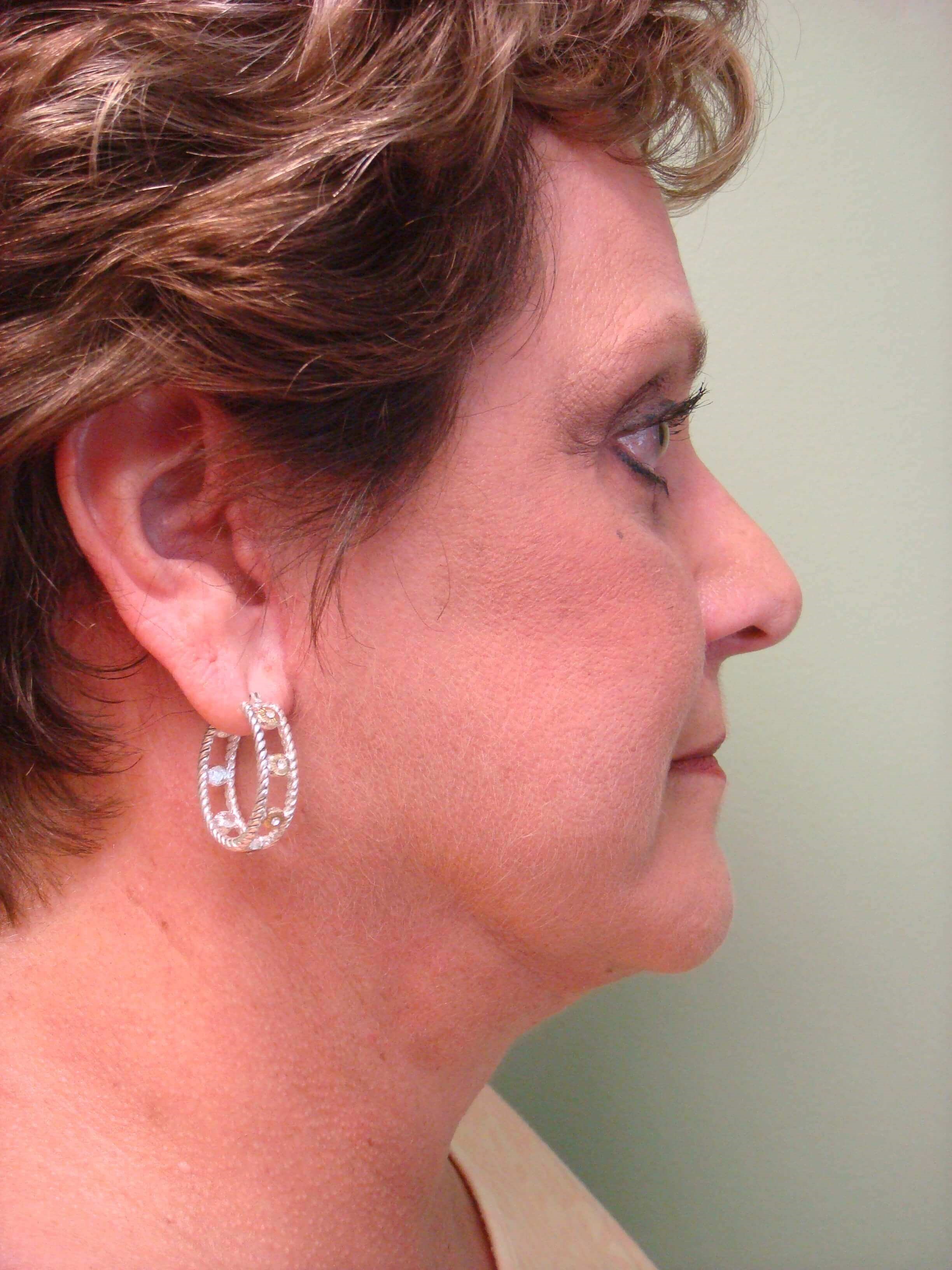 Facelift and Necklift After