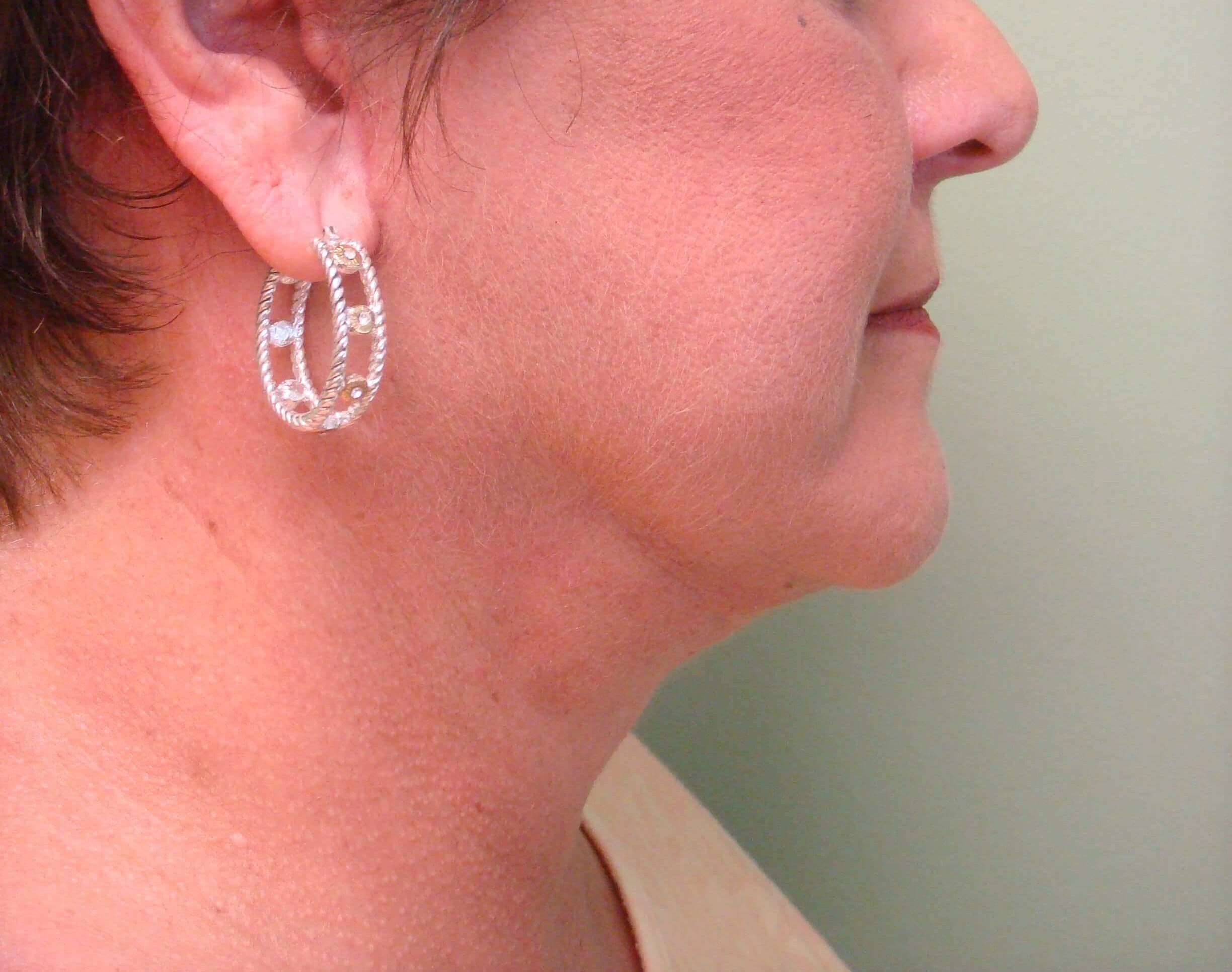 Facelift and Necklift After