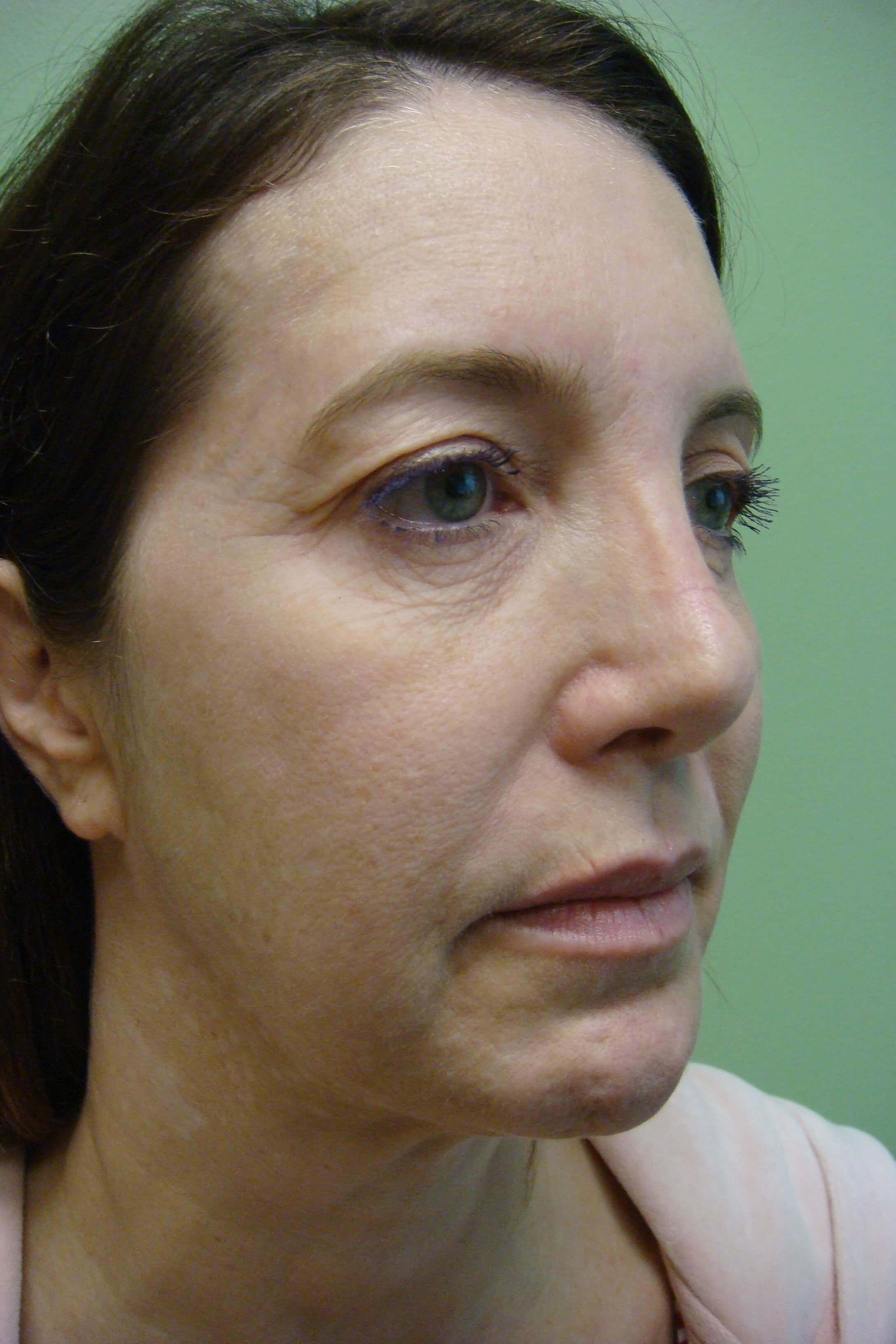 Facelift Before