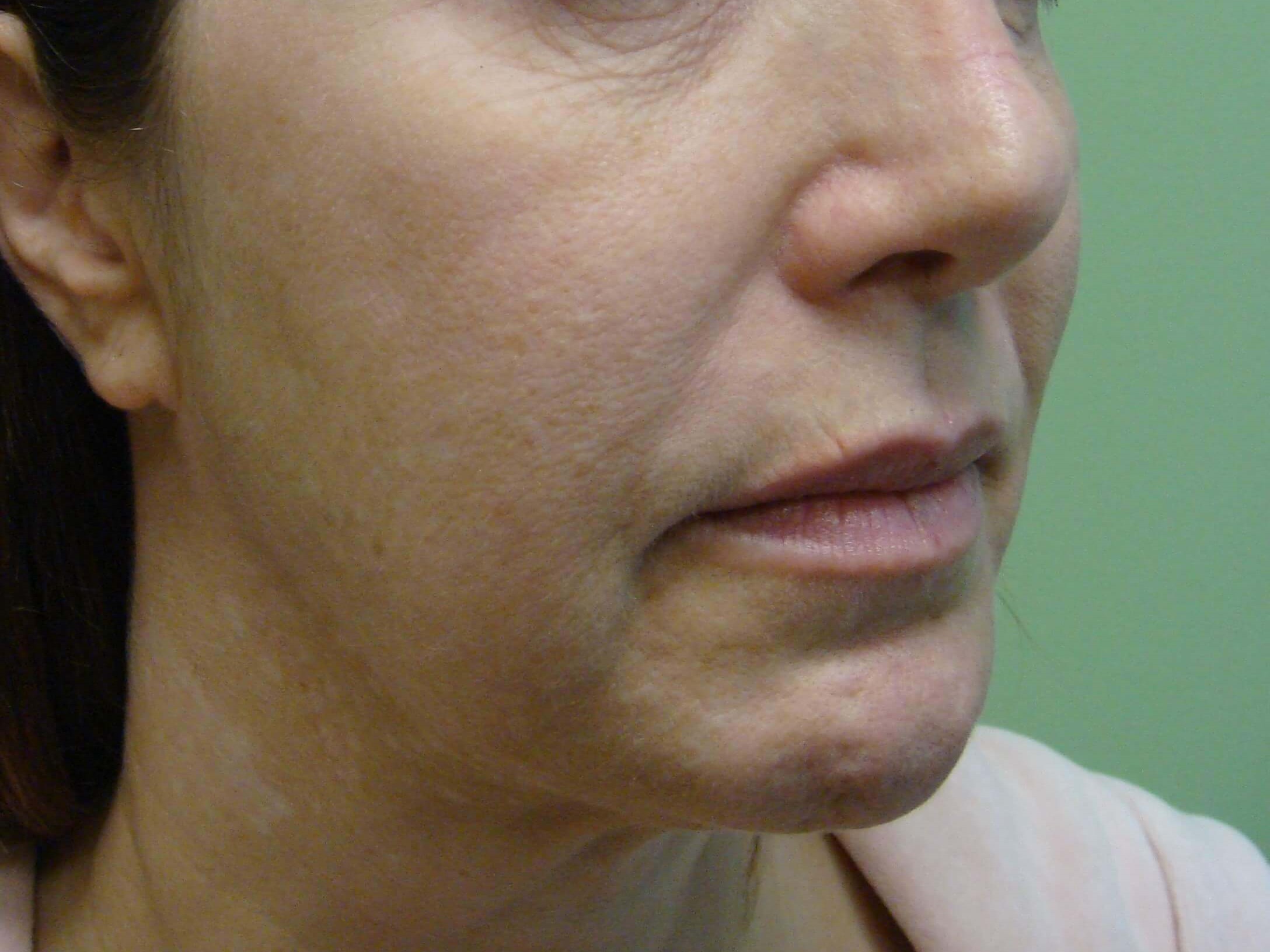 Facelift Before