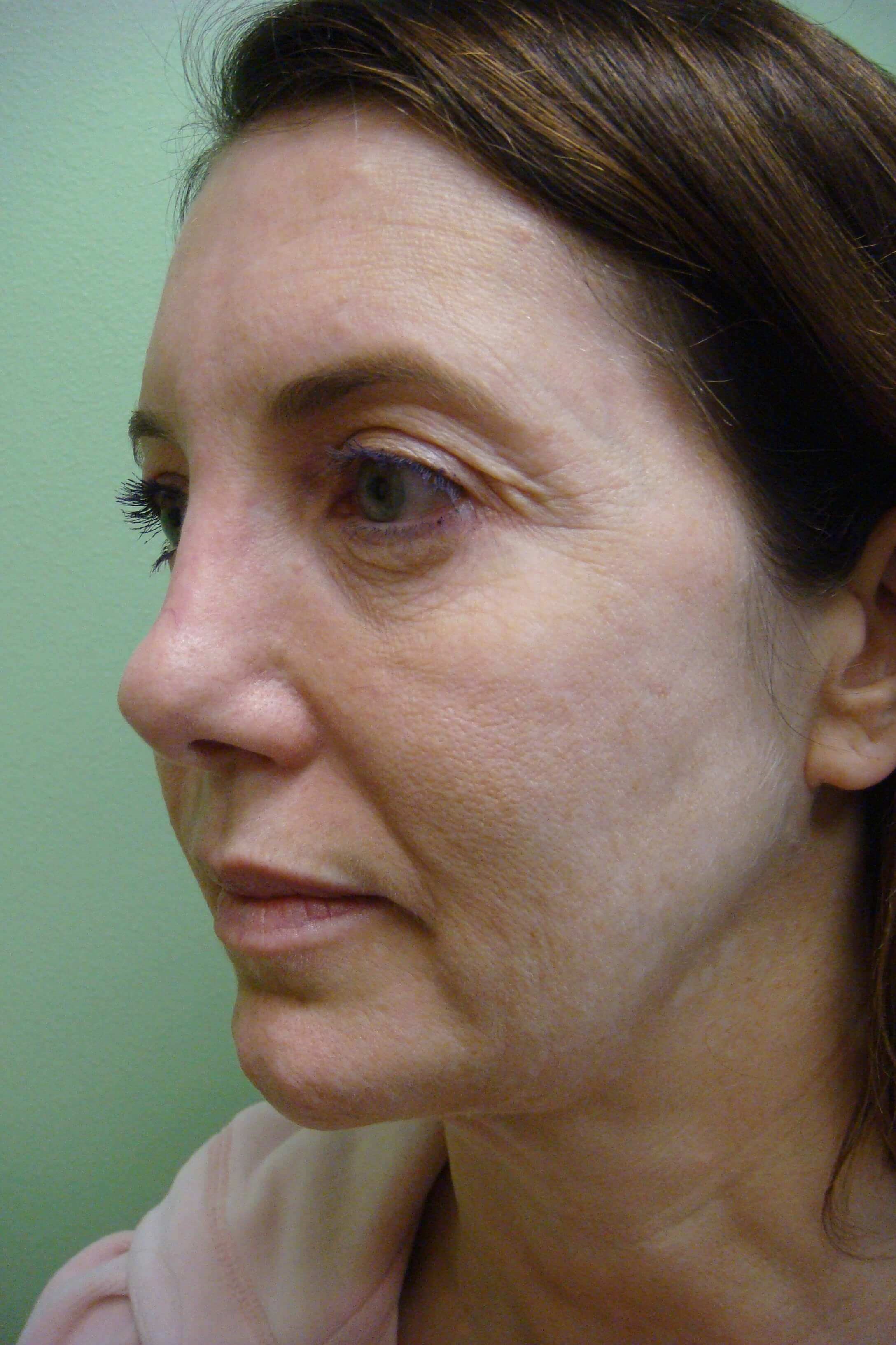 Facelift Before