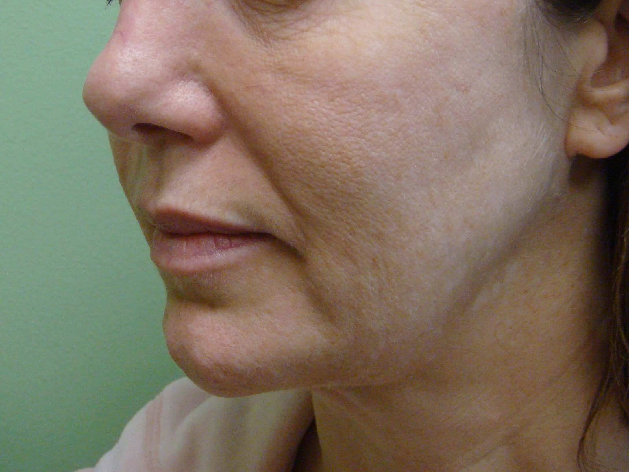 Facelift Before