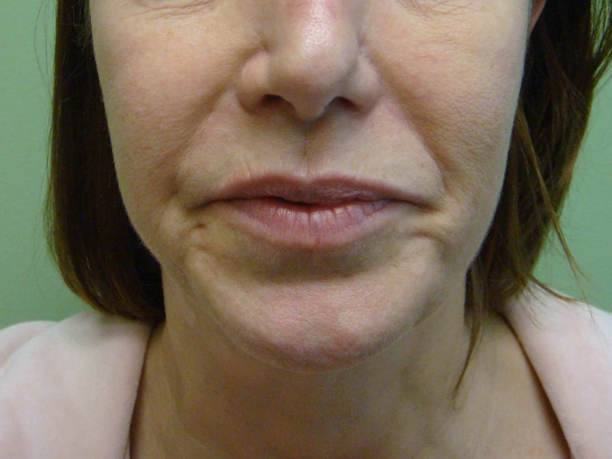 Facelift Before