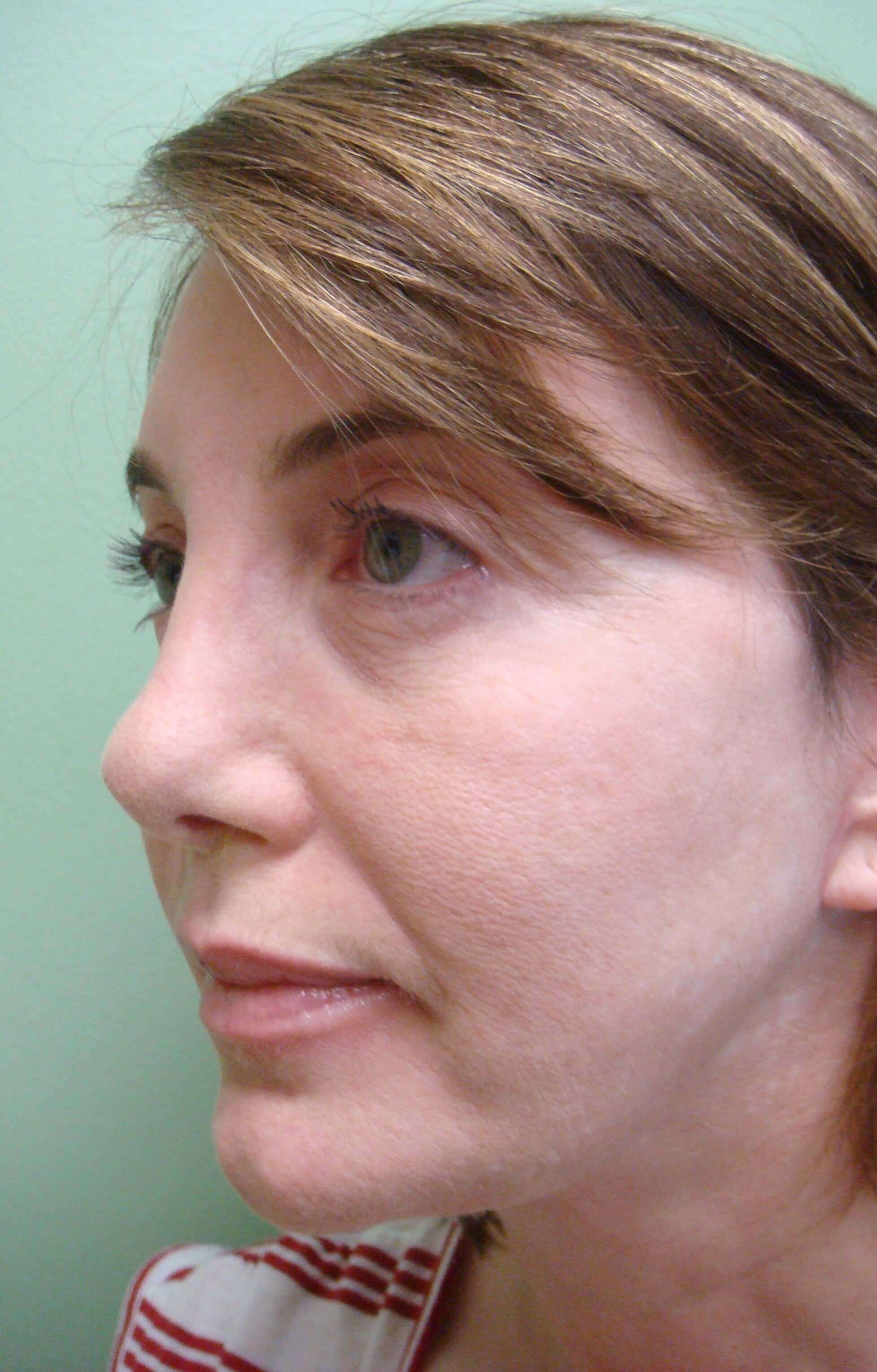 Facelift After