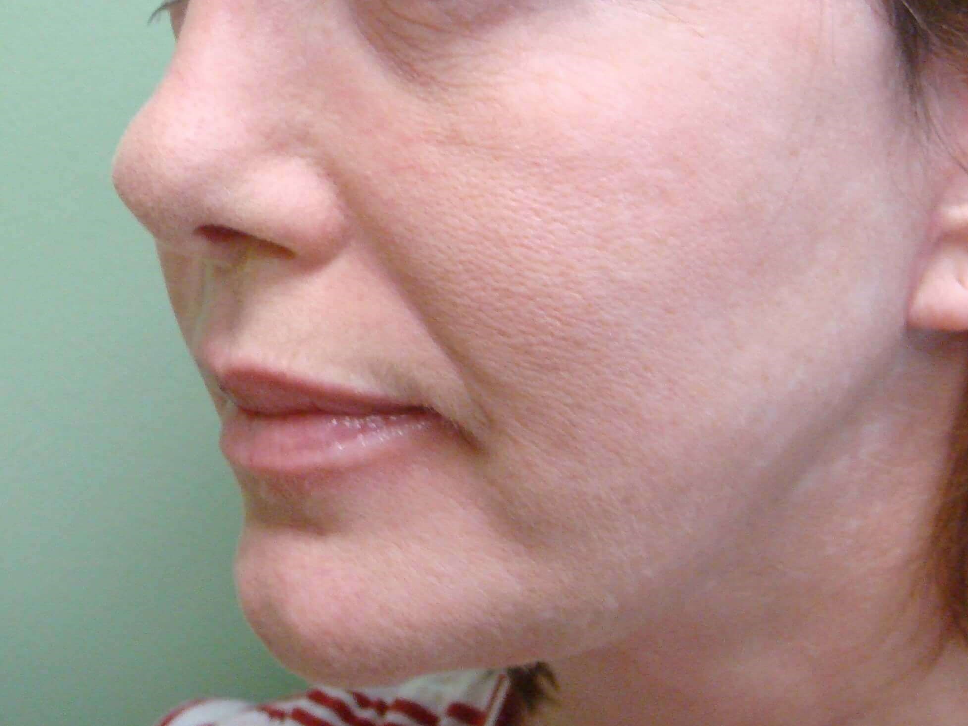 Facelift After