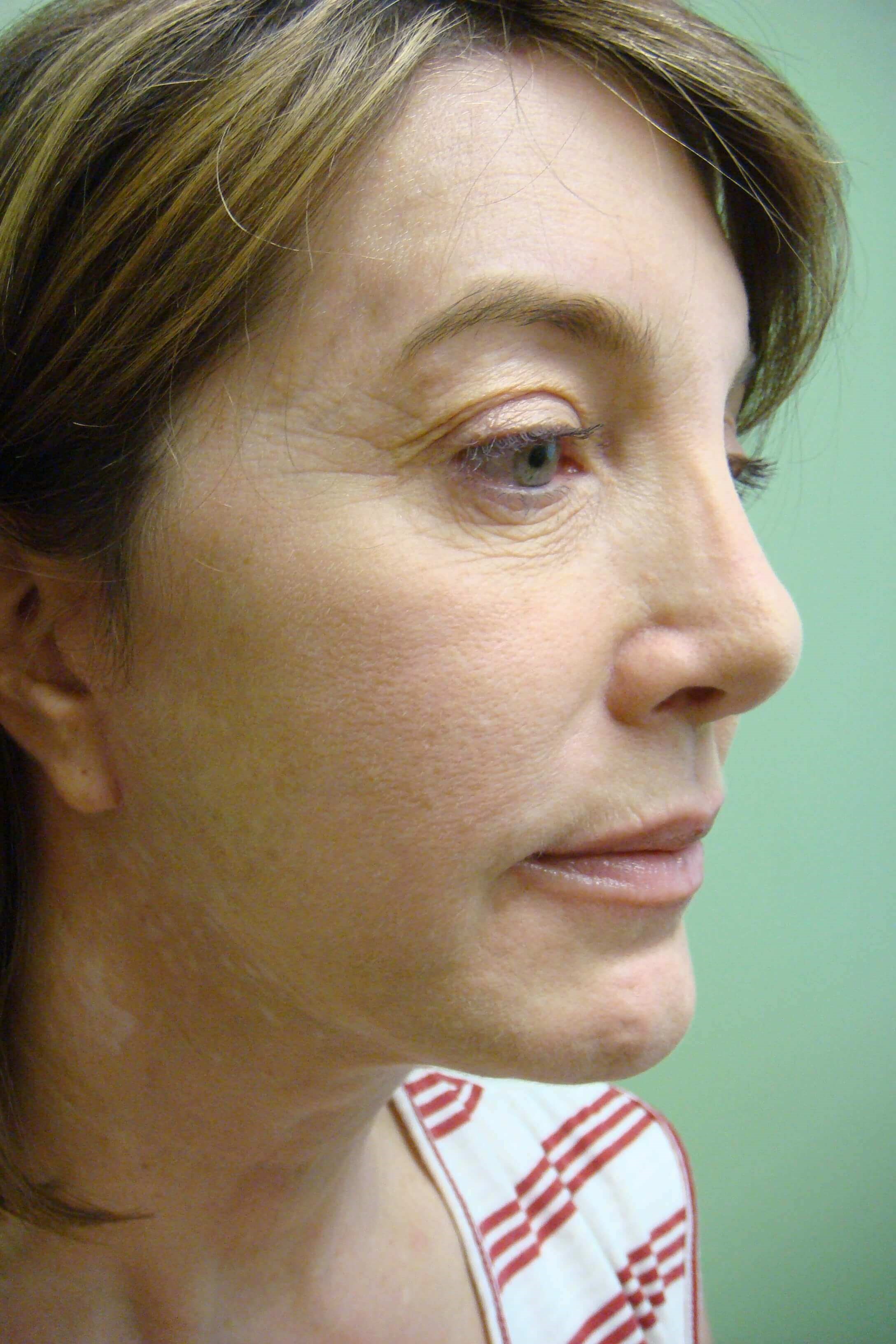 Facelift After