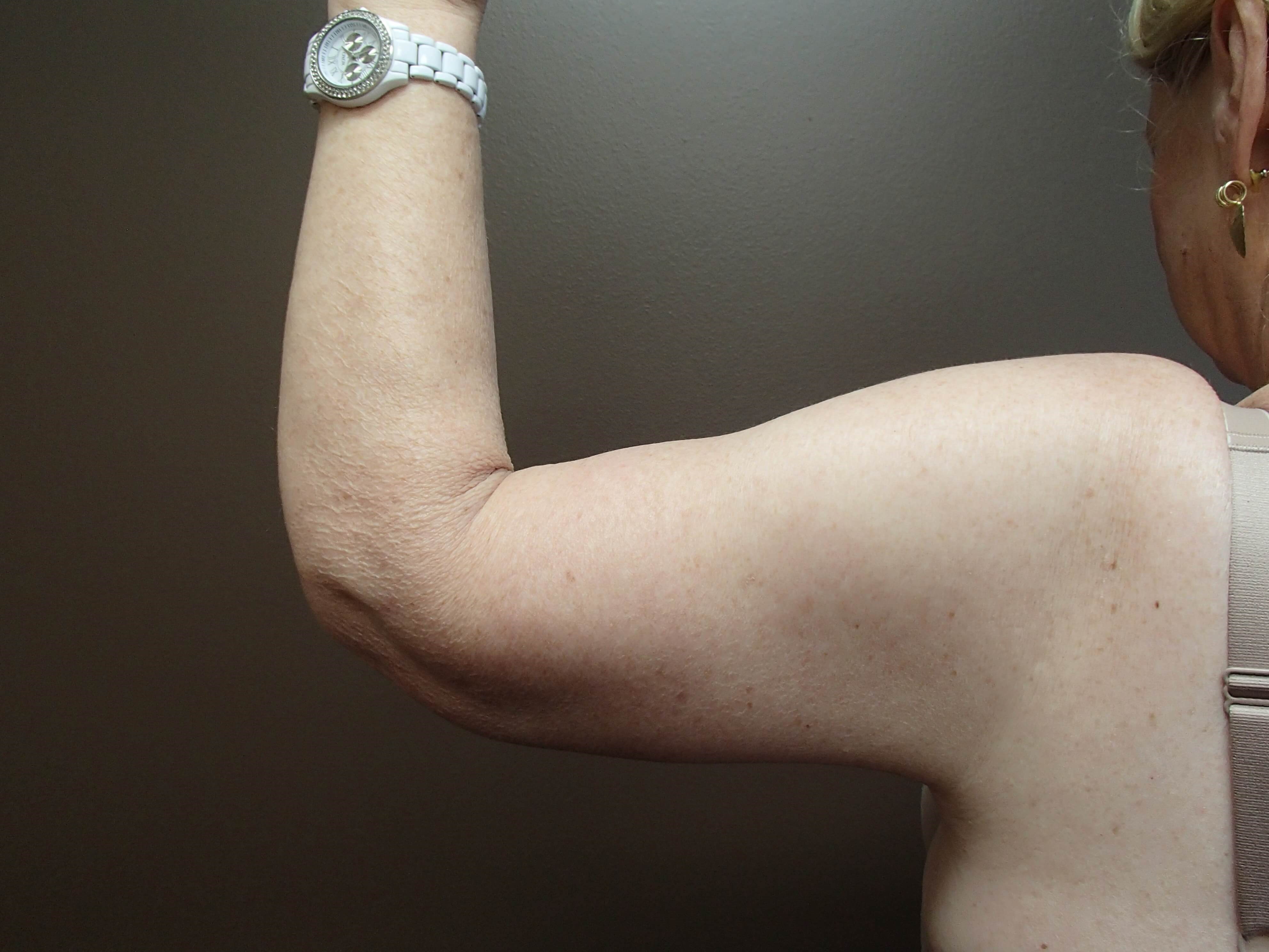 Brachioplasty (Arm Lift) After