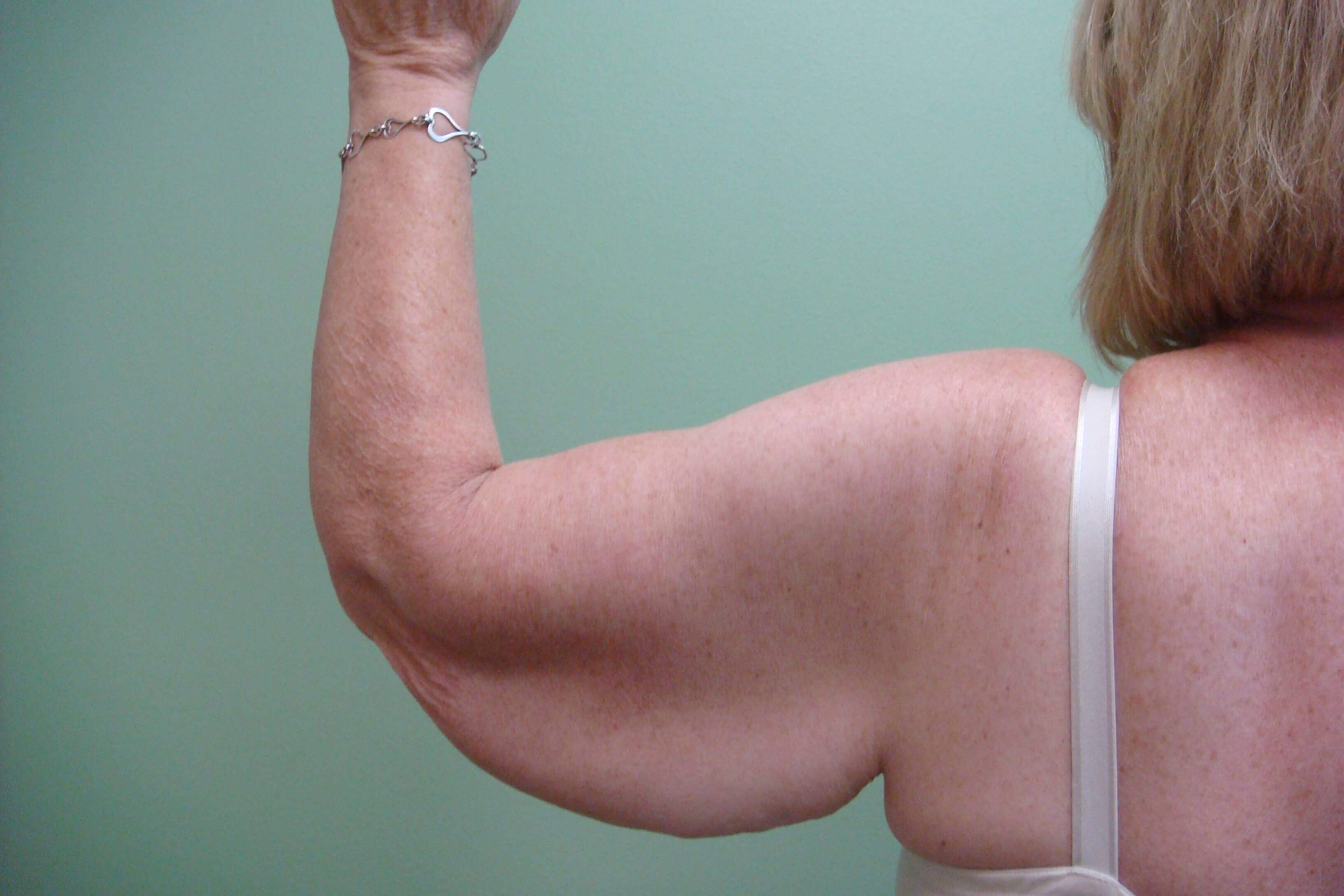 Brachioplasty (Arm Lift) Before
