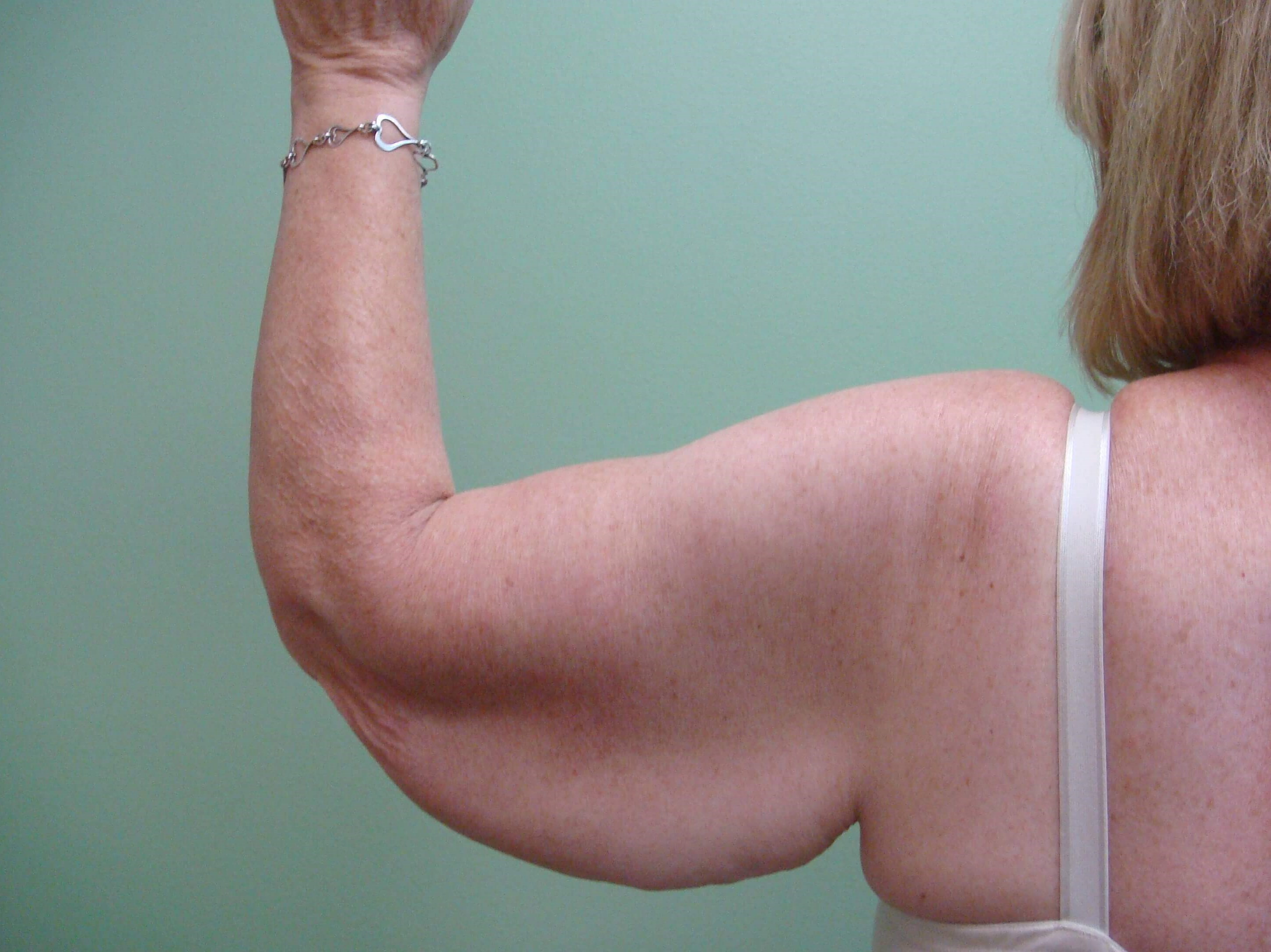 Brachioplasty (Arm Lift) Before
