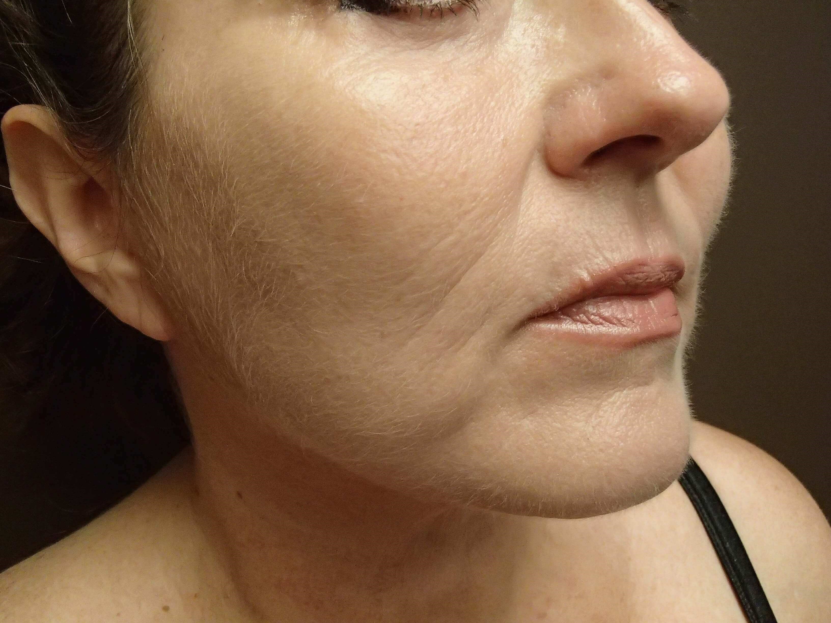 Facelift and Necklift After